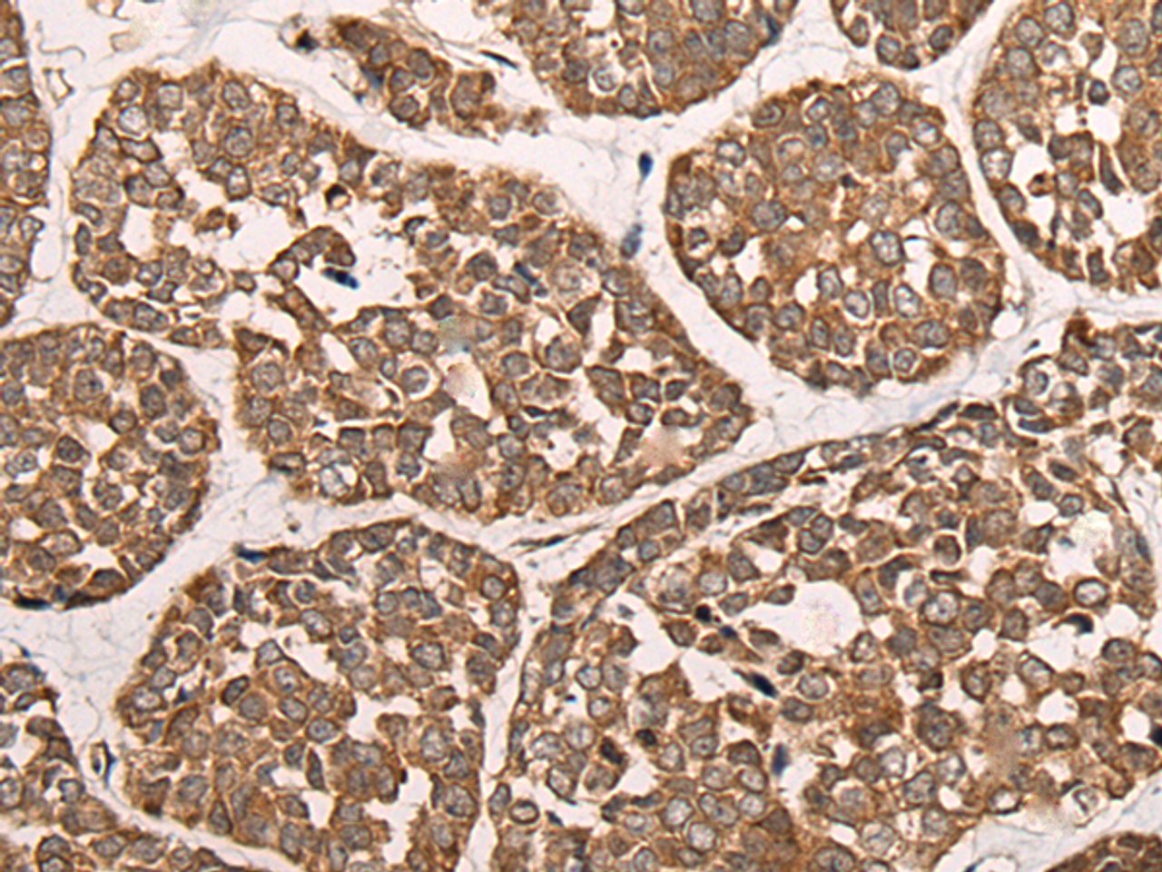 Immunohistochemistry of paraffin-embedded Human esophagus cancer tissue  using CAD Polyclonal Antibody at dilution of 1:50(×200)