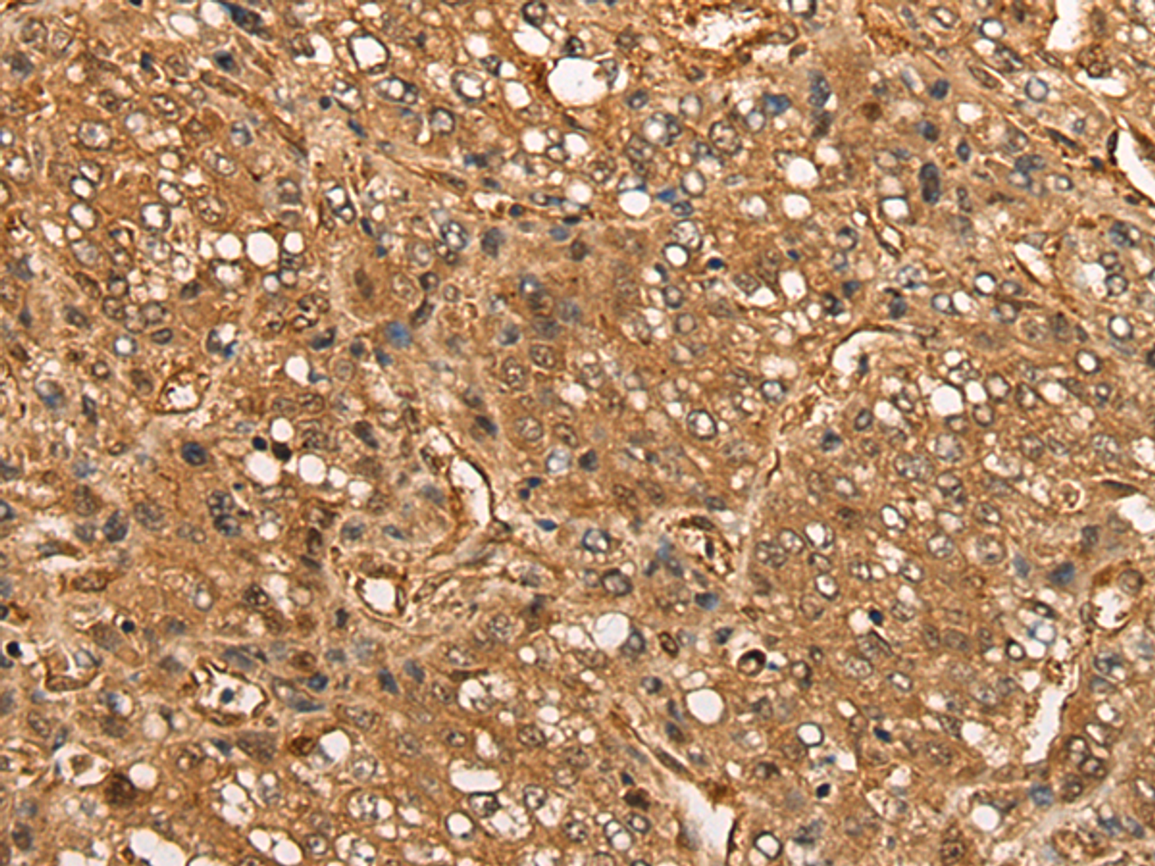 Immunohistochemistry of paraffin-embedded Human liver cancer tissue  using CALML6 Polyclonal Antibody at dilution of 1:55(×200)