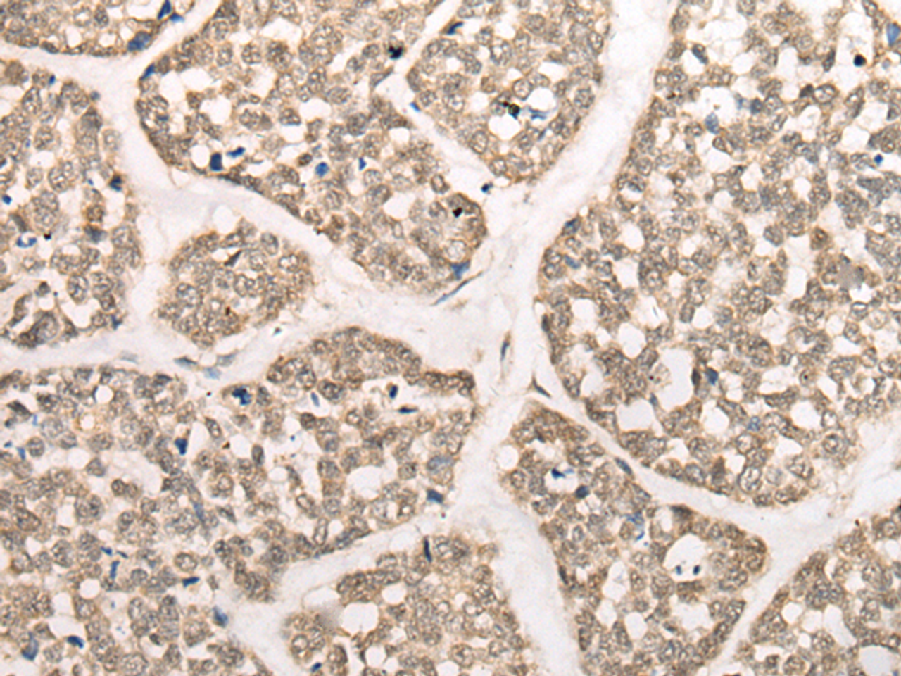 Immunohistochemistry of paraffin-embedded Human esophagus cancer tissue  using CAPN15 Polyclonal Antibody at dilution of 1:50(×200)