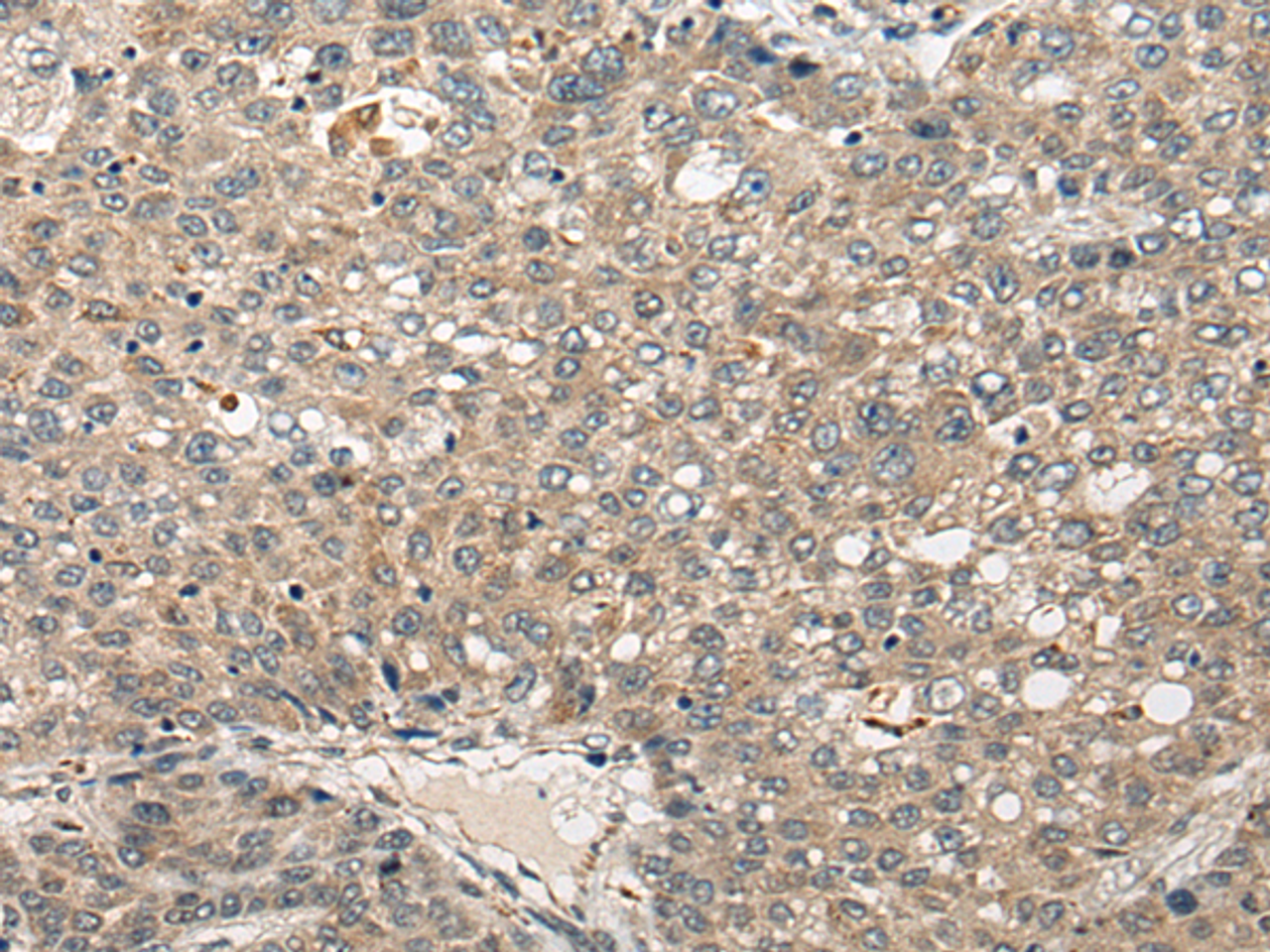 Immunohistochemistry of paraffin-embedded Human liver cancer tissue  using FUT4 Polyclonal Antibody at dilution of 1:40(×200)
