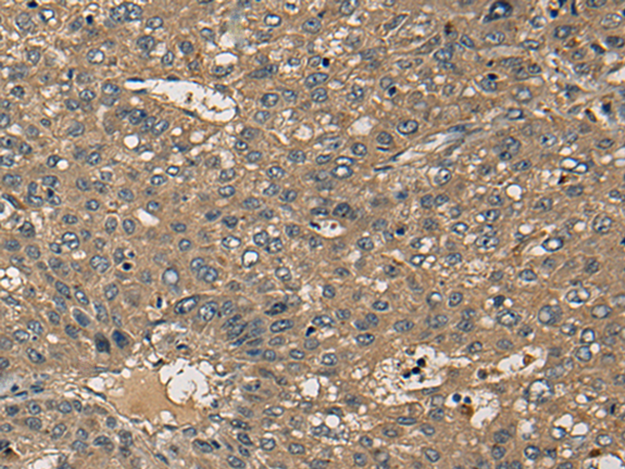 Immunohistochemistry of paraffin-embedded Human liver cancer tissue  using CD1B Polyclonal Antibody at dilution of 1:55(×200)