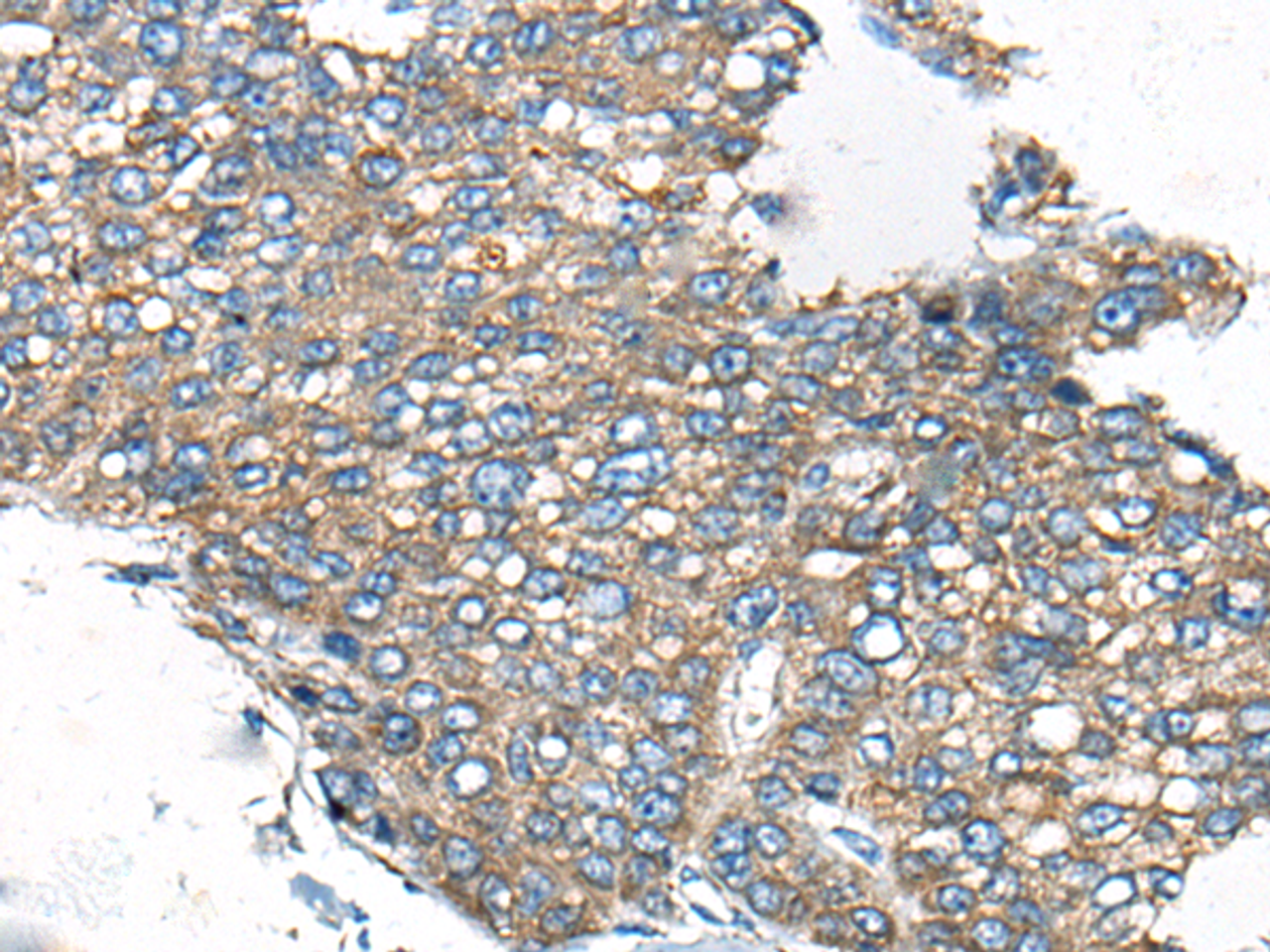 Immunohistochemistry of paraffin-embedded Human liver cancer tissue  using CDC42BPA Polyclonal Antibody at dilution of 1:60(×200)