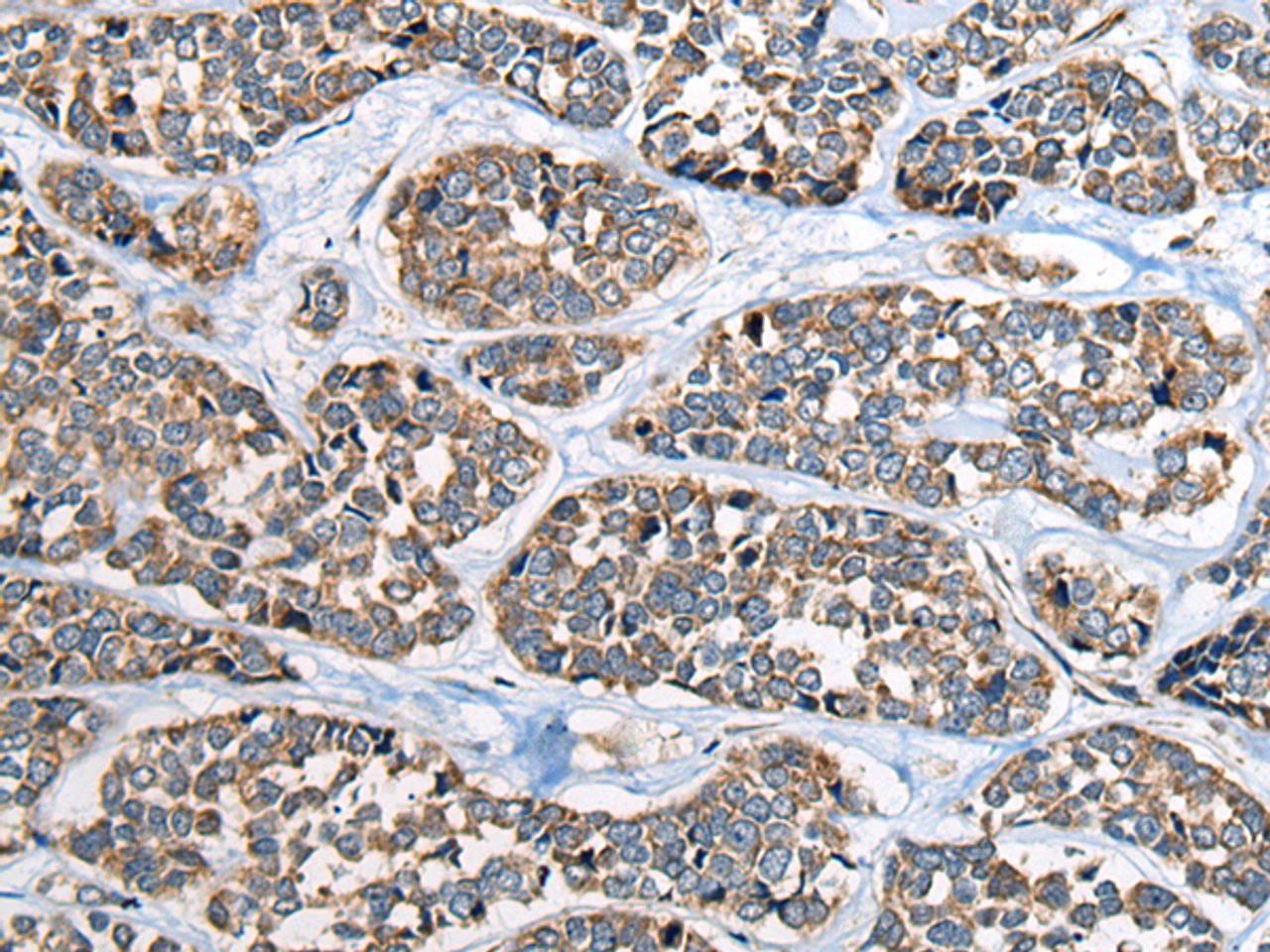 Immunohistochemistry of paraffin-embedded Human esophagus cancer tissue  using CADM2 Polyclonal Antibody at dilution of 1:40(×200)
