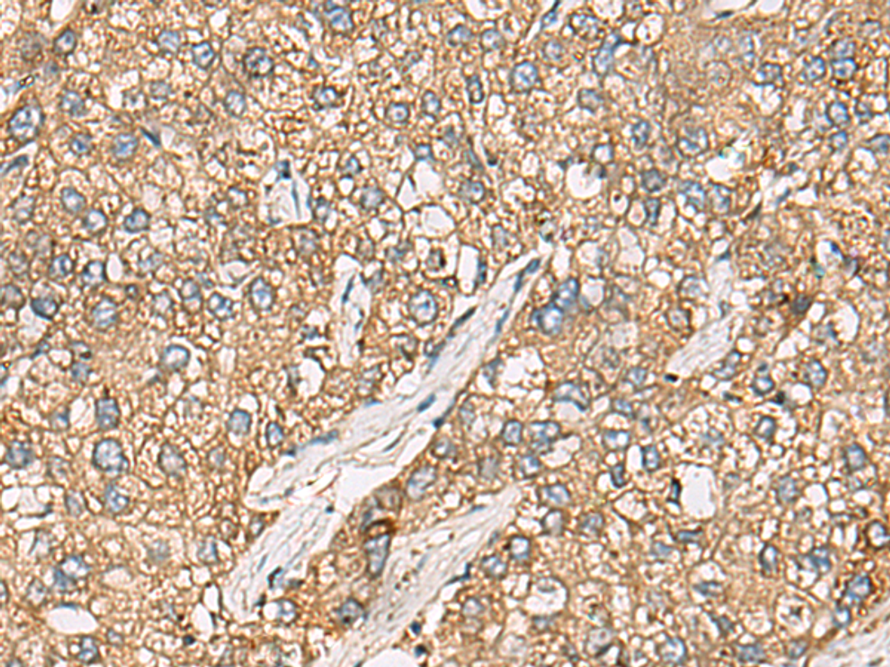 Immunohistochemistry of paraffin-embedded Human liver cancer tissue  using CHKA Polyclonal Antibody at dilution of 1:35(×200)