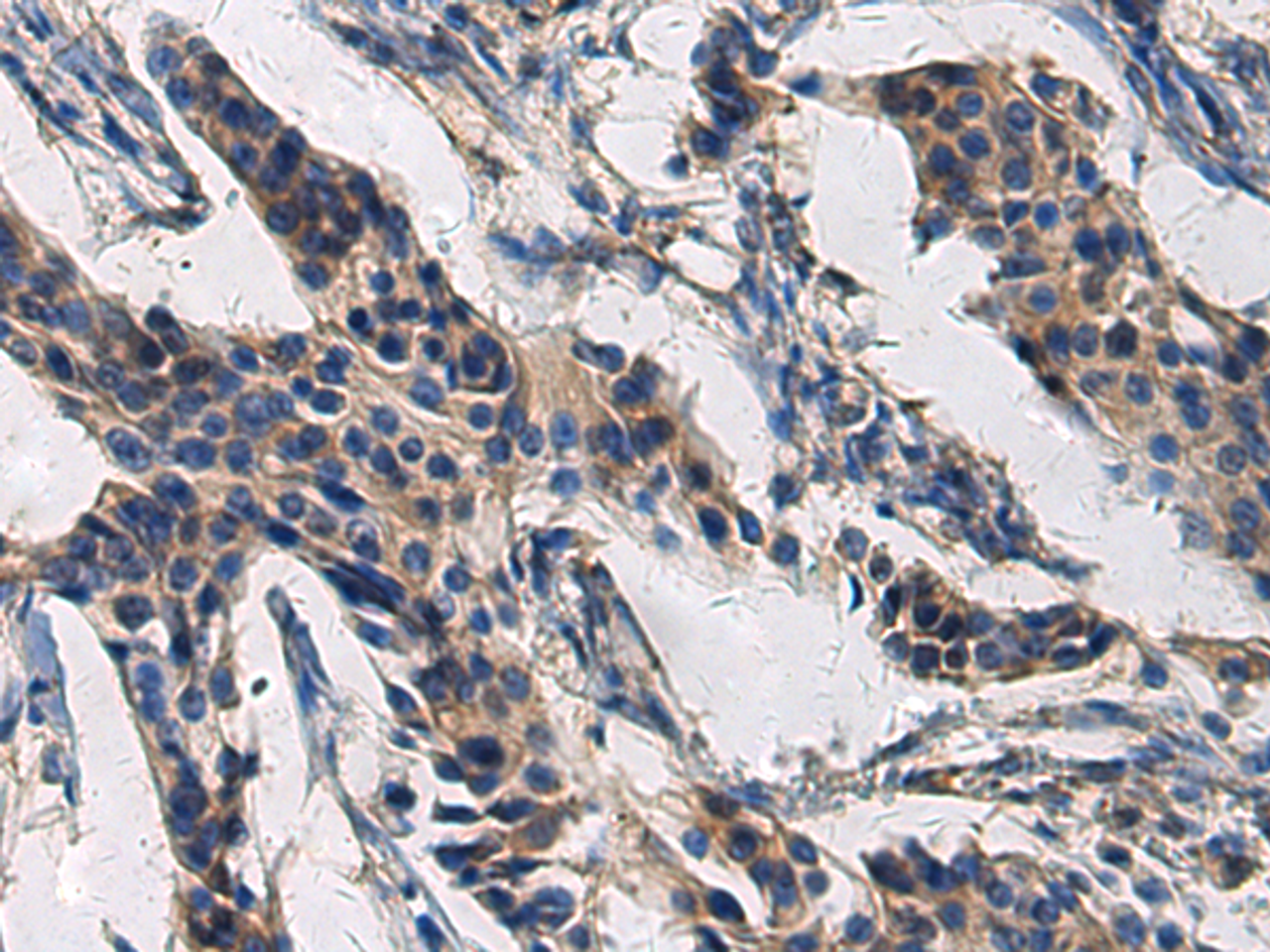 Immunohistochemistry of paraffin-embedded Human breast cancer tissue  using COL17A1 Polyclonal Antibody at dilution of 1:50(×200)