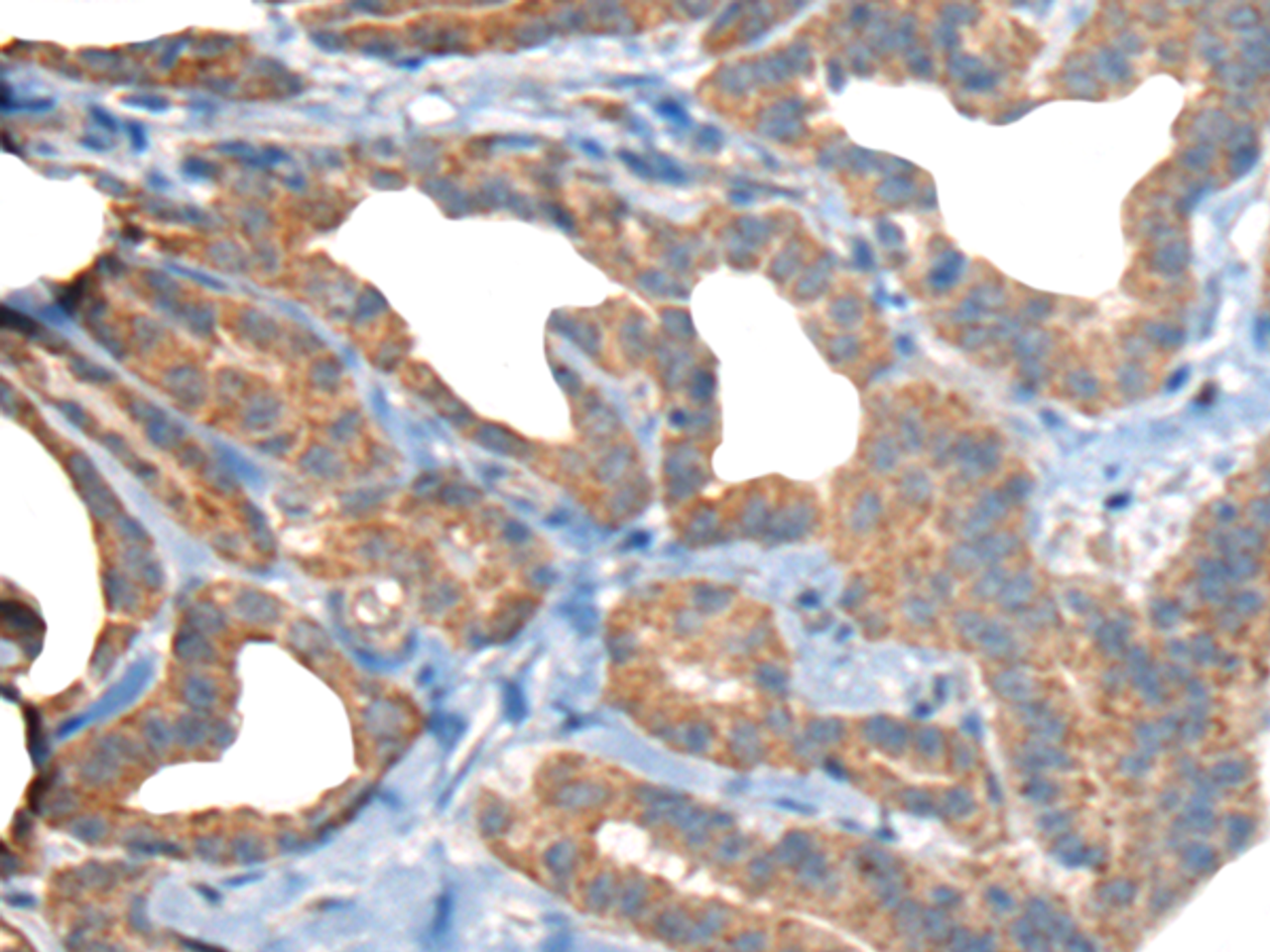 Immunohistochemistry of paraffin-embedded Human thyroid cancer tissue  using RTN4IP1 Polyclonal Antibody at dilution of 1:50(×200)