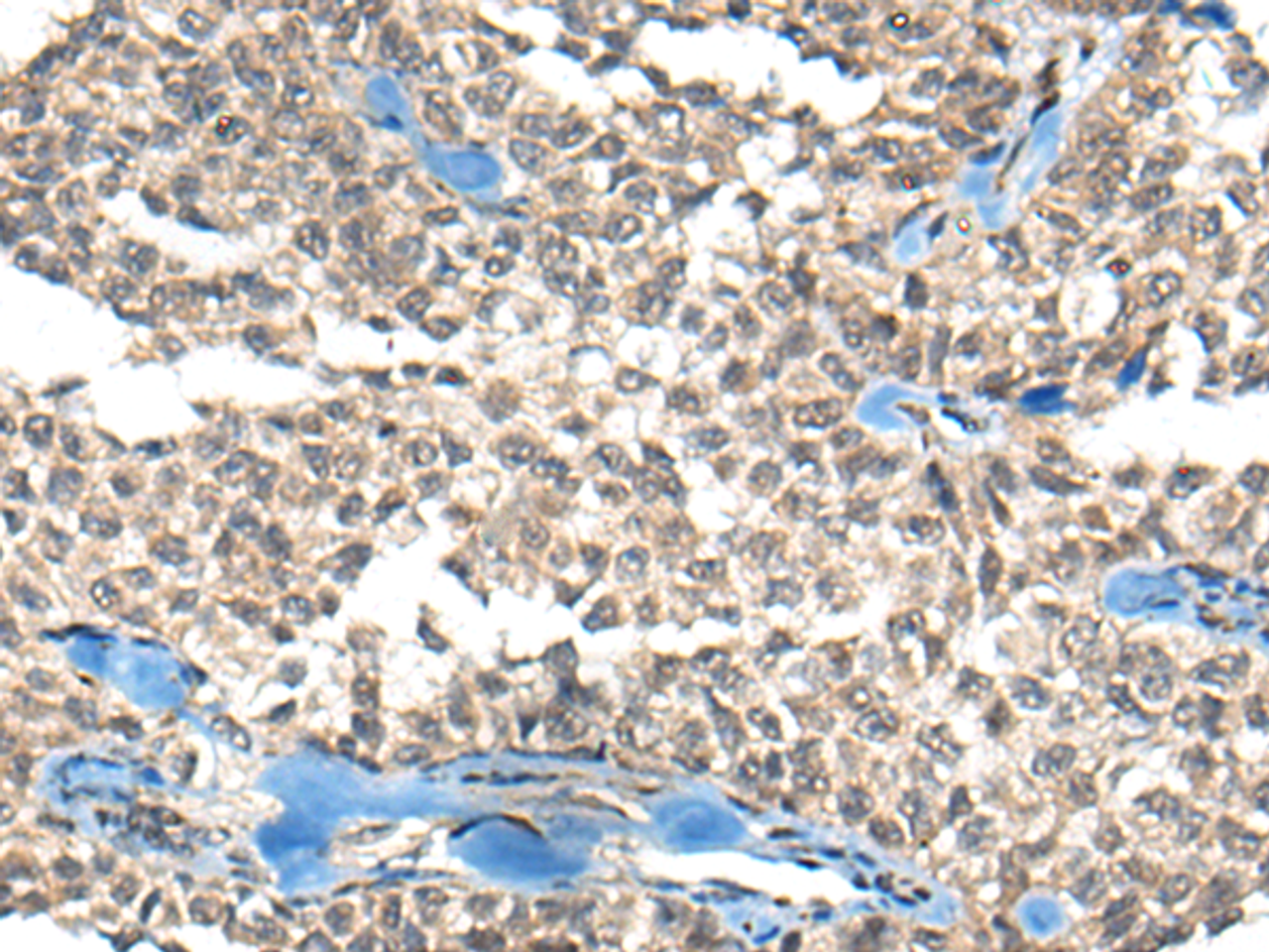 Immunohistochemistry of paraffin-embedded Human ovarian cancer tissue  using REST Polyclonal Antibody at dilution of 1:50(×200)