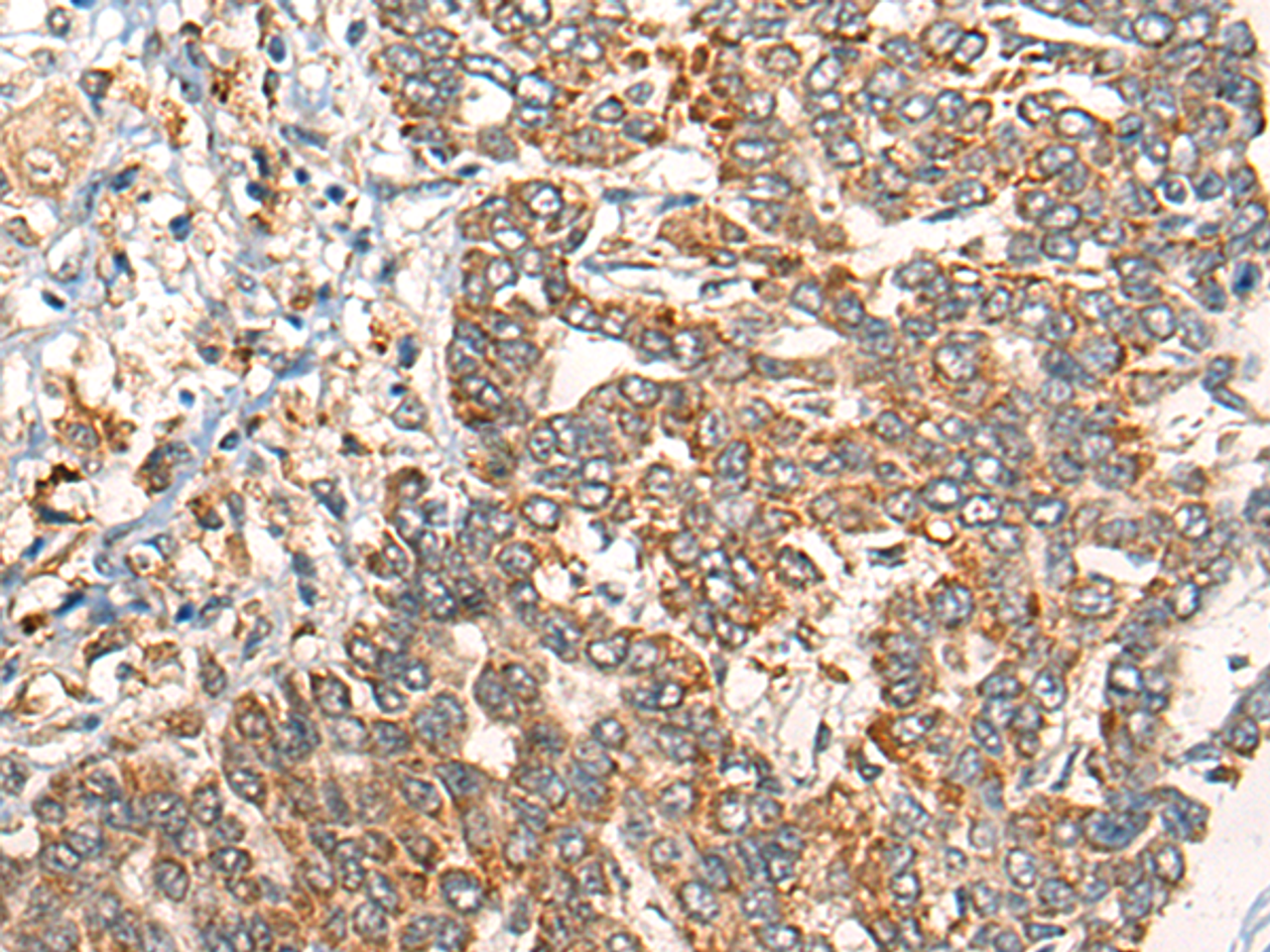 Immunohistochemistry of paraffin-embedded Human liver cancer tissue  using EPHA6 Polyclonal Antibody at dilution of 1:40(×200)