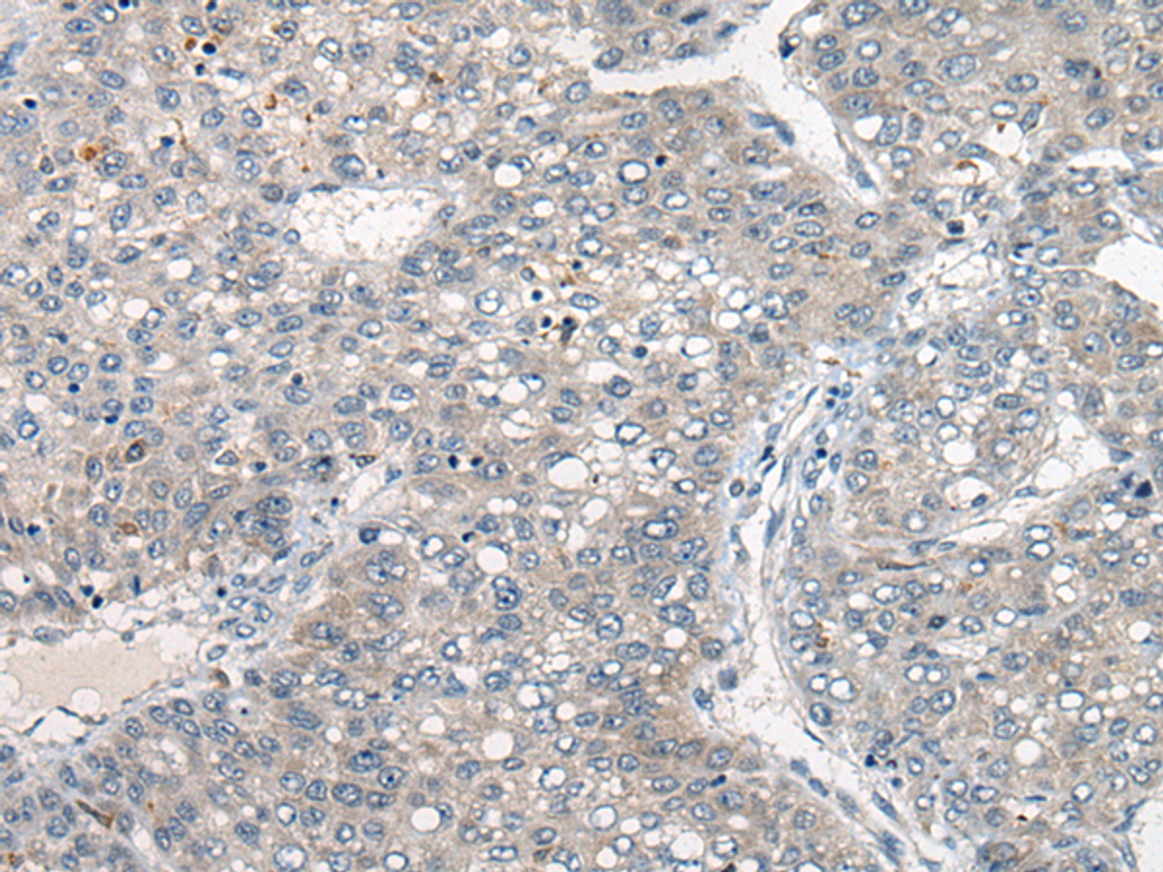 Immunohistochemistry of paraffin-embedded Human liver cancer tissue  using DGKI Polyclonal Antibody at dilution of 1:80(×200)