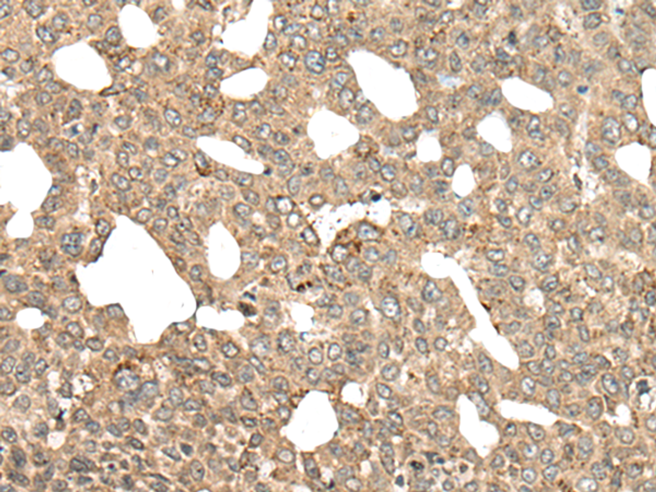 Immunohistochemistry of paraffin-embedded Human liver cancer tissue  using APC Polyclonal Antibody at dilution of 1:45(×200)