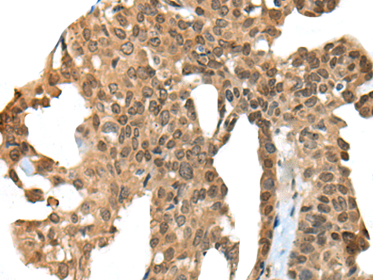 Immunohistochemistry of paraffin-embedded Human thyroid cancer tissue  using APC Polyclonal Antibody at dilution of 1:45(×200)
