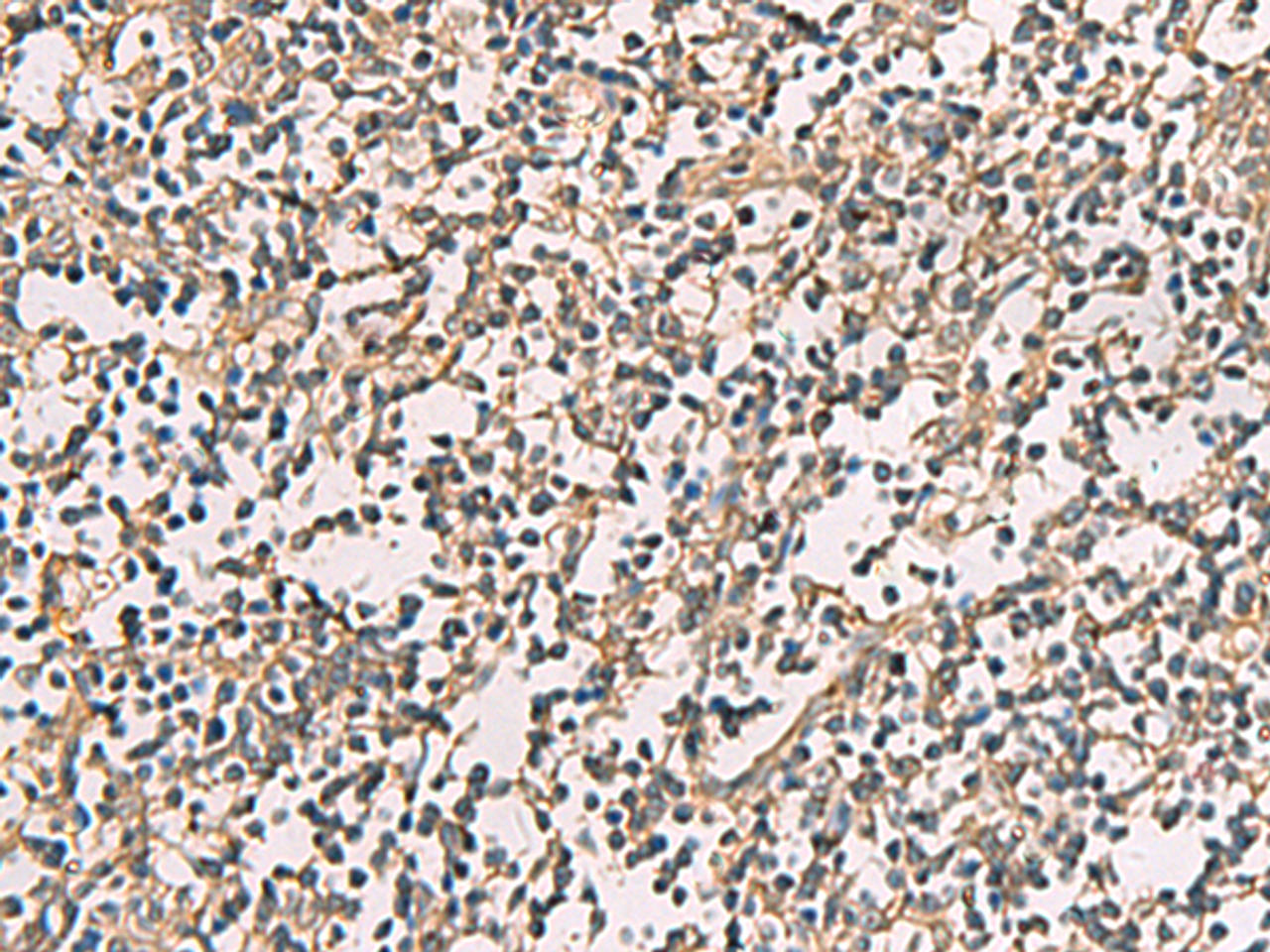 Immunohistochemistry of paraffin-embedded Human tonsil tissue  using CMTM4 Polyclonal Antibody at dilution of 1:55(×200)