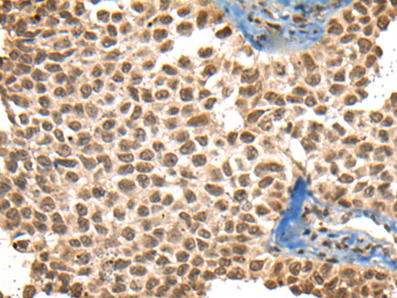 Immunohistochemistry of paraffin-embedded Human ovarian cancer tissue  using XPO1 Polyclonal Antibody at dilution of 1:40(×200)