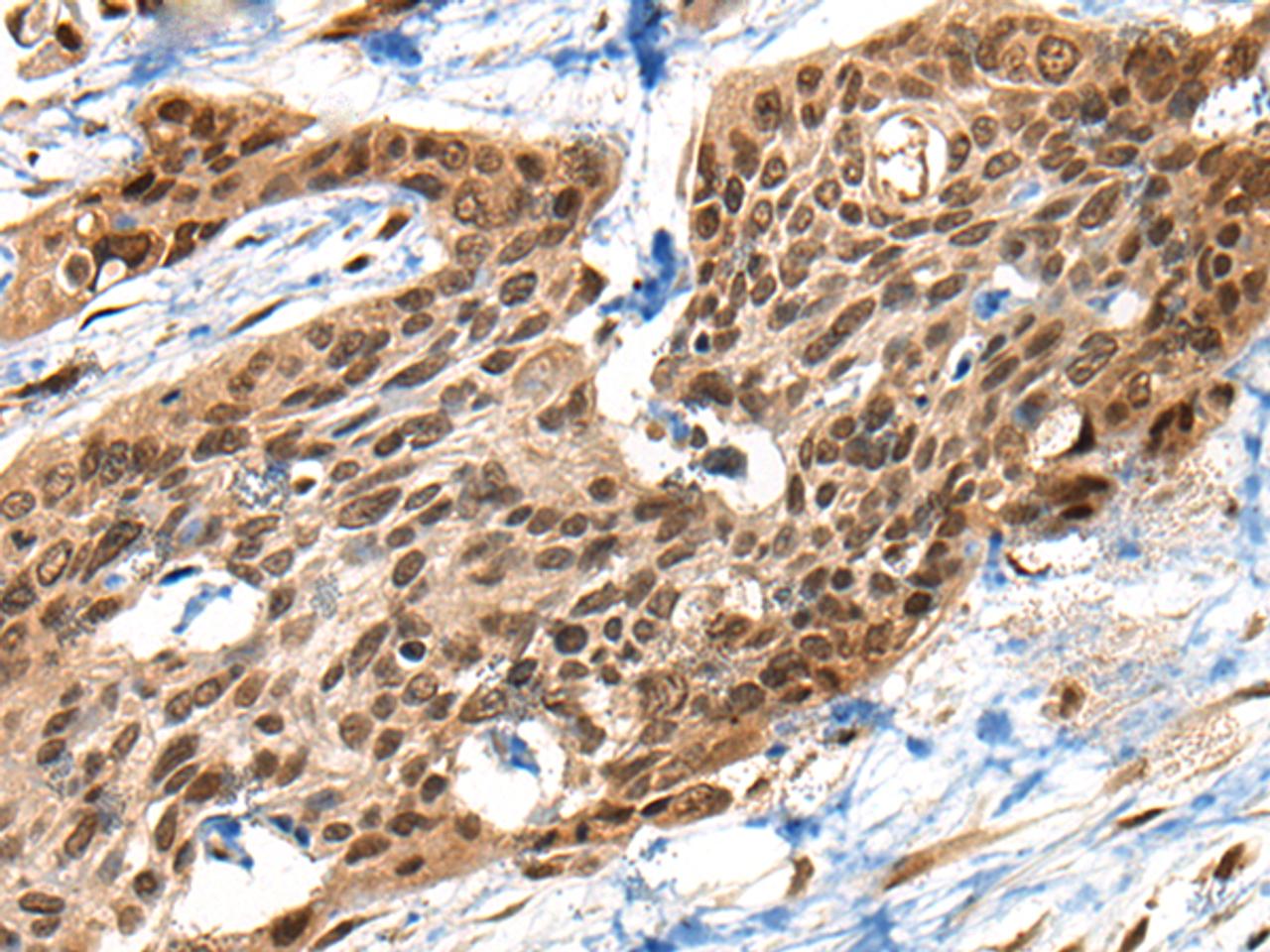 Immunohistochemistry of paraffin-embedded Human esophagus cancer tissue  using XPO1 Polyclonal Antibody at dilution of 1:40(×200)