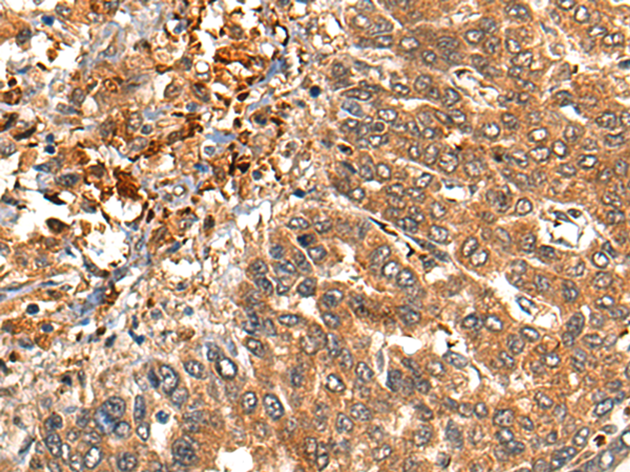 Immunohistochemistry of paraffin-embedded Human liver cancer tissue  using MARK3 Polyclonal Antibody at dilution of 1:40(×200)