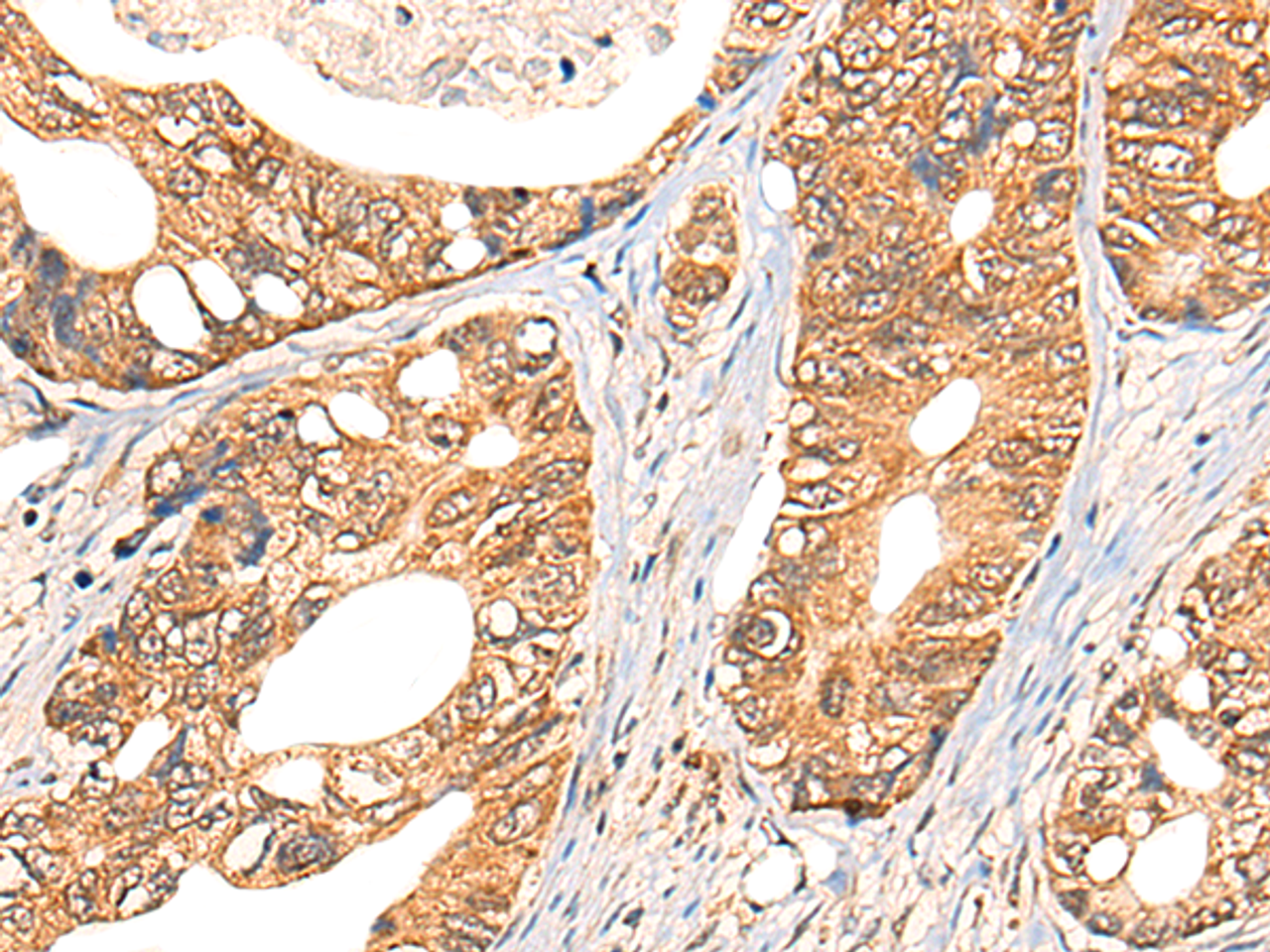 Immunohistochemistry of paraffin-embedded Human gastric cancer tissue  using NOL8 Polyclonal Antibody at dilution of 1:40(×200)