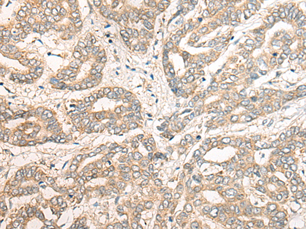 Immunohistochemistry of paraffin-embedded Human liver cancer tissue  using PCDHGB5 Polyclonal Antibody at dilution of 1:40(×200)