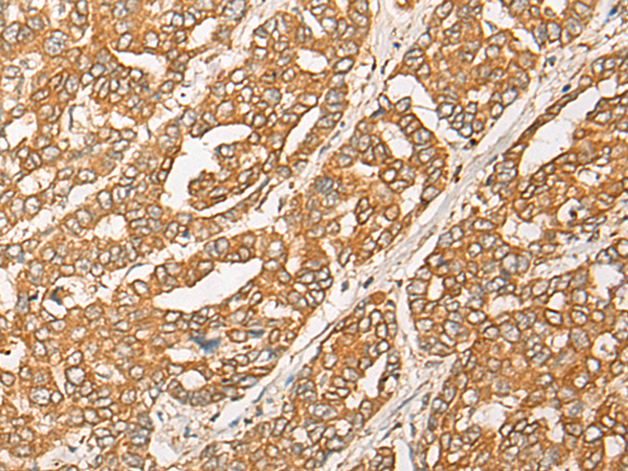 Immunohistochemistry of paraffin-embedded Human liver cancer tissue  using GNB1L Polyclonal Antibody at dilution of 1:35(×200)