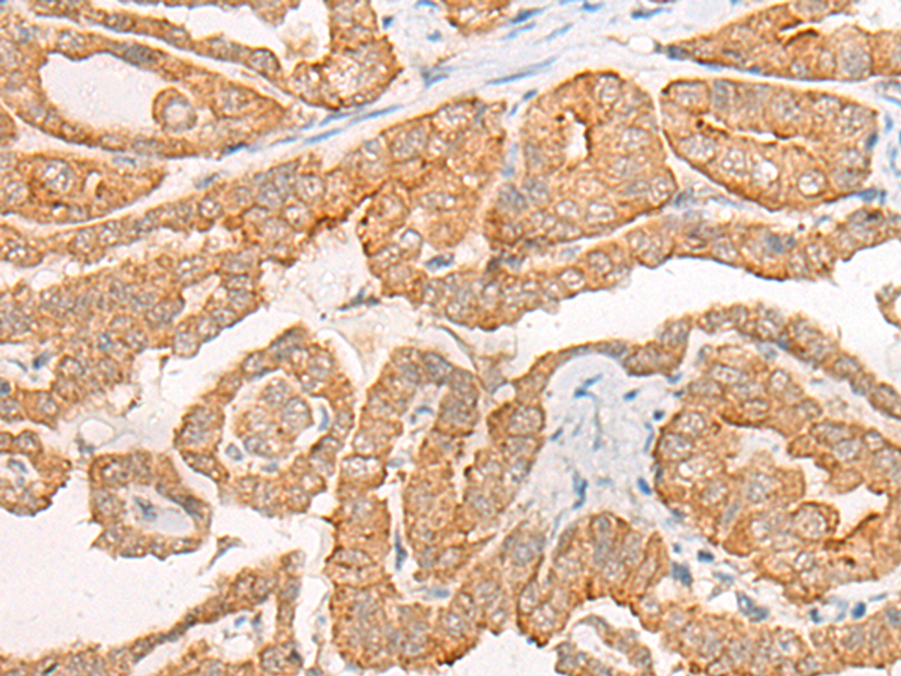 Immunohistochemistry of paraffin-embedded Human thyroid cancer tissue  using CYB5D1 Polyclonal Antibody at dilution of 1:45(×200)