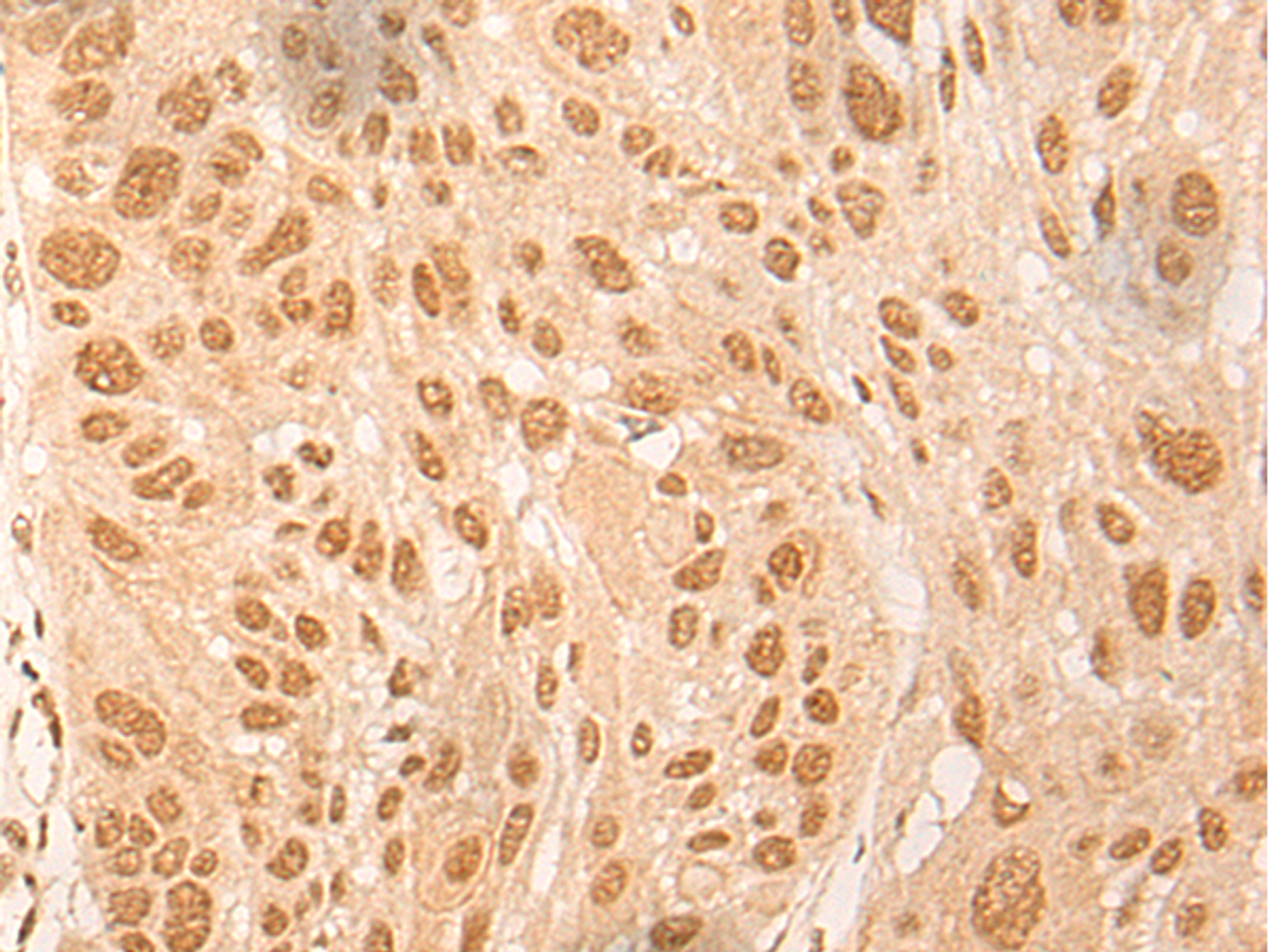 Immunohistochemistry of paraffin-embedded Human esophagus cancer tissue  using DBP Polyclonal Antibody at dilution of 1:25(×200)
