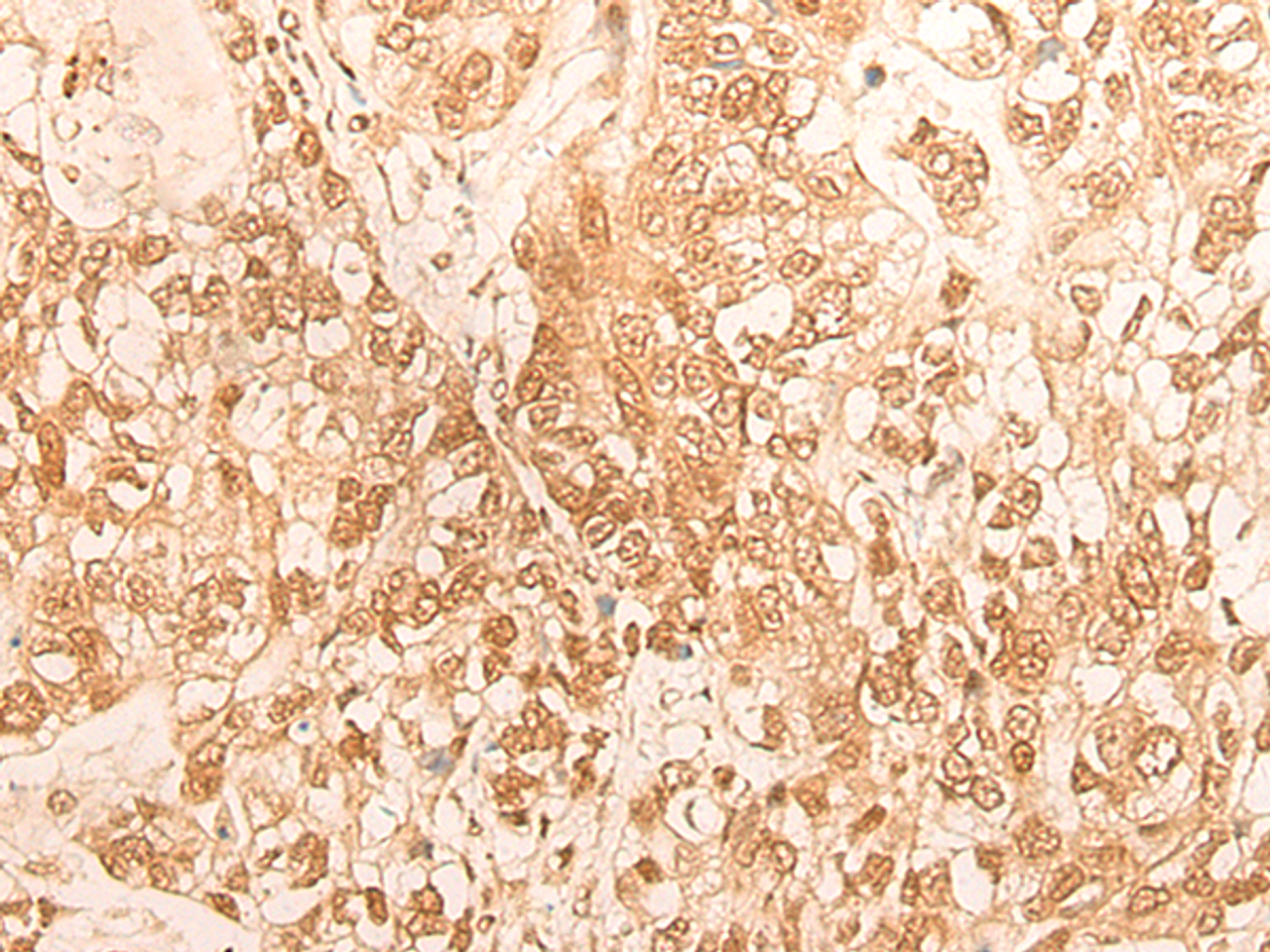 Immunohistochemistry of paraffin-embedded Human gastric cancer tissue  using DBP Polyclonal Antibody at dilution of 1:25(×200)