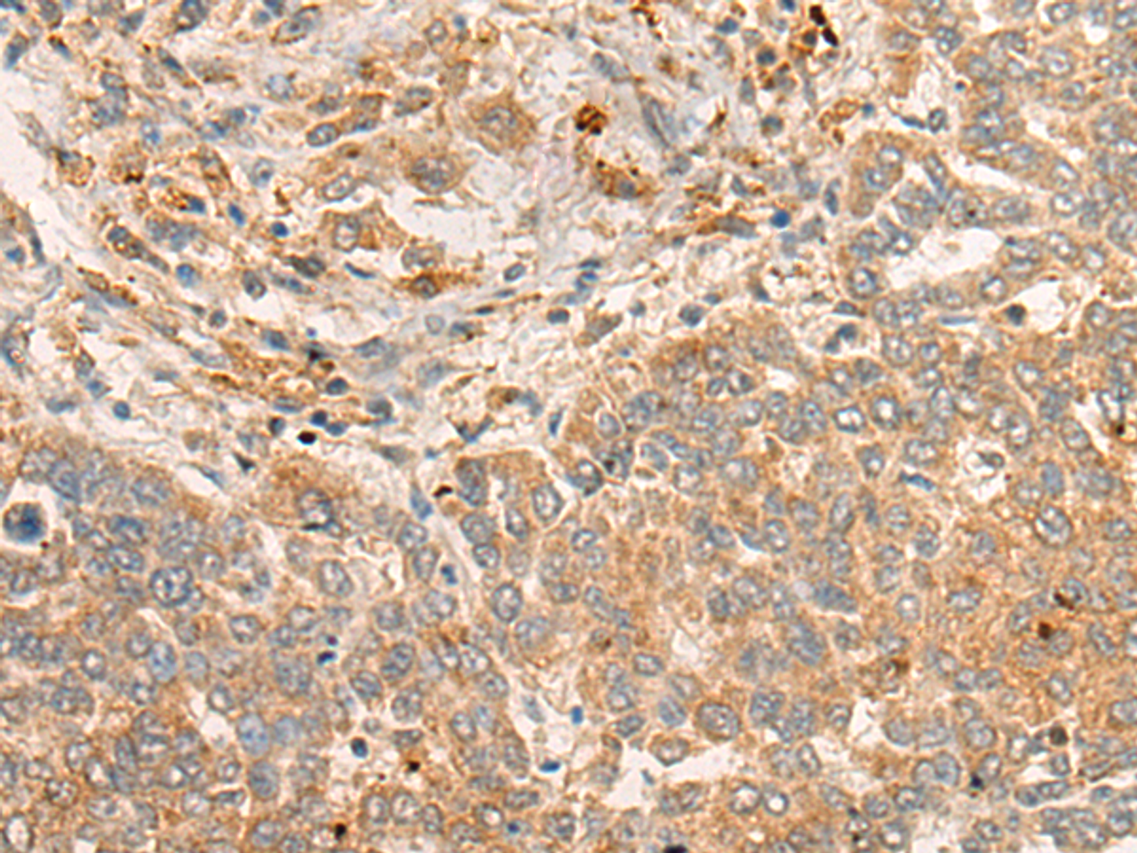 Immunohistochemistry of paraffin-embedded Human liver cancer tissue  using FBXO32 Polyclonal Antibody at dilution of 1:45(×200)