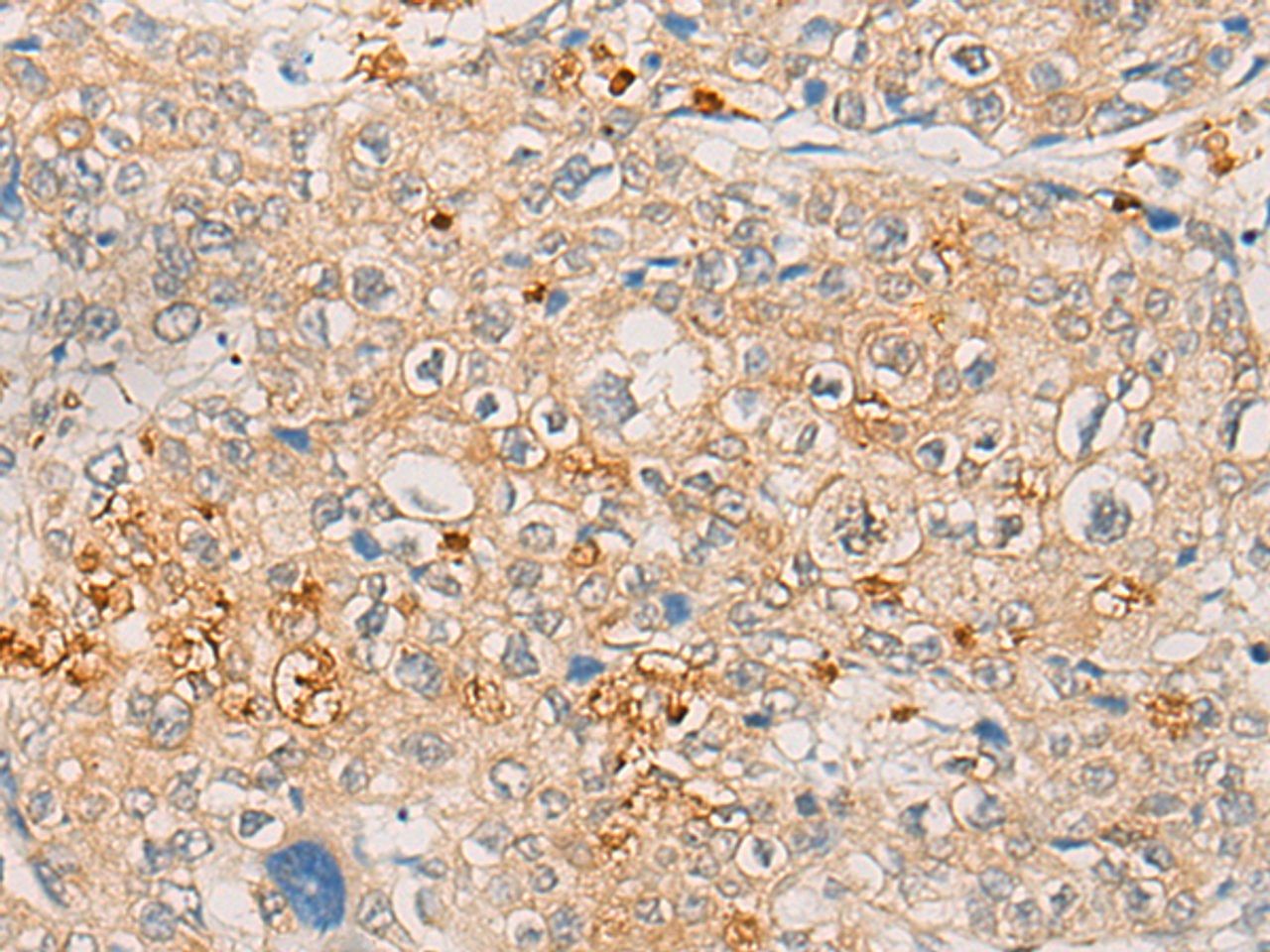 Immunohistochemistry of paraffin-embedded Human prost ate cancer tissue  using FBXO32 Polyclonal Antibody at dilution of 1:45(×200)