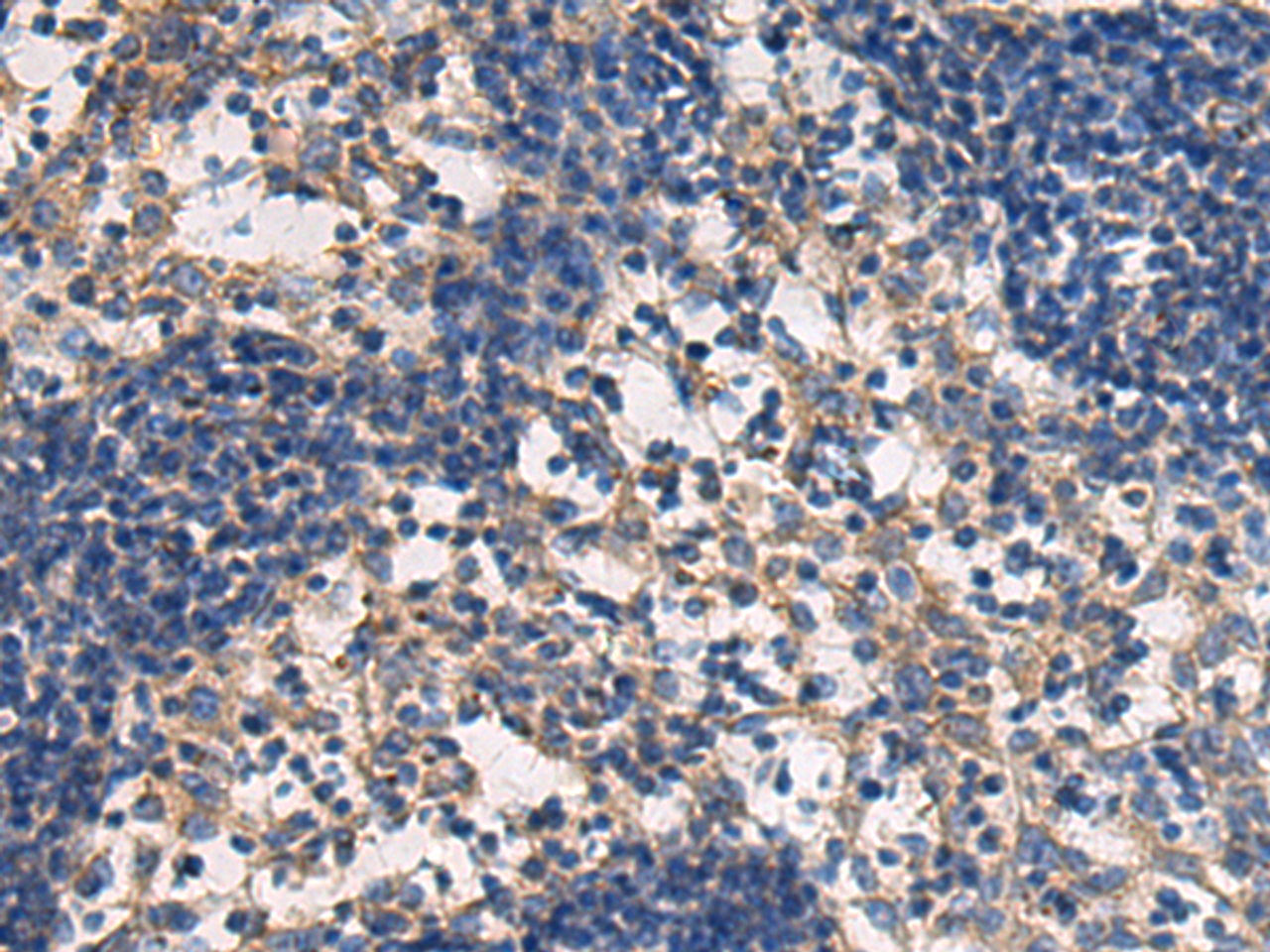 Immunohistochemistry of paraffin-embedded Human esophagus cancer tissue  using DMRTA2 Polyclonal Antibody at dilution of 1:50(×200)