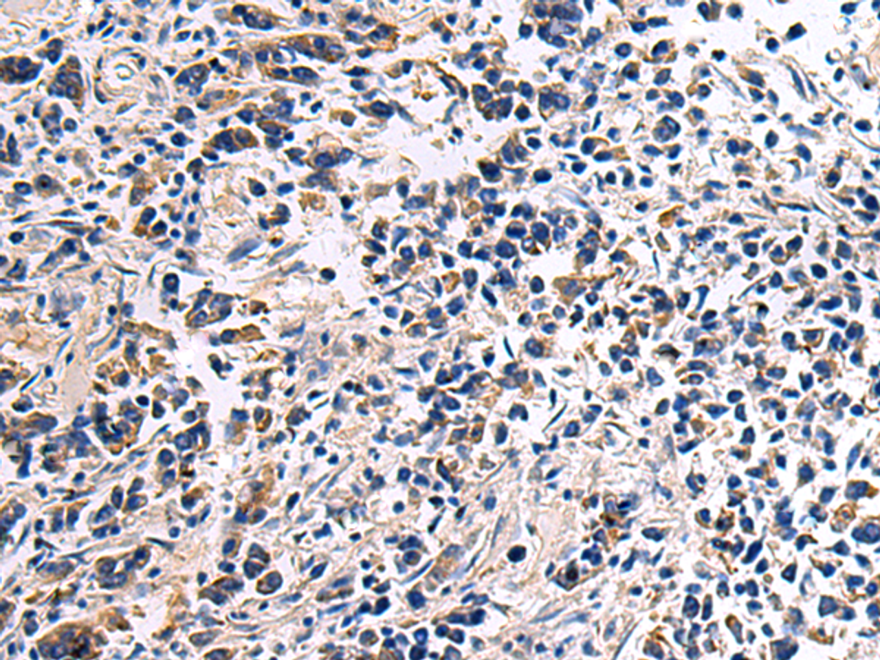 Immunohistochemistry of paraffin-embedded Human breast cancer tissue  using DRGX Polyclonal Antibody at dilution of 1:45(×200)