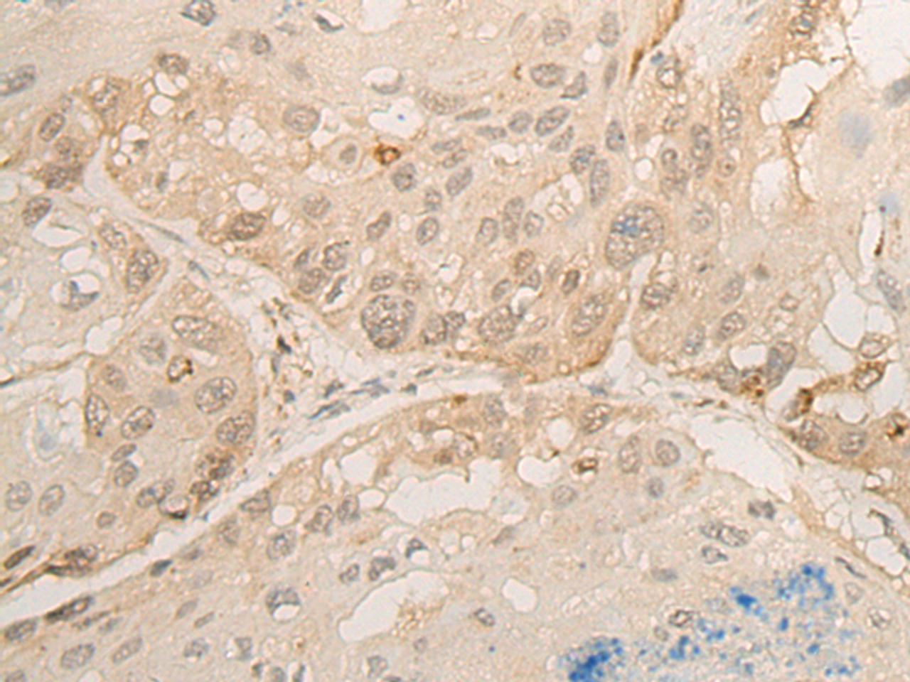 Immunohistochemistry of paraffin-embedded Human esophagus cancer tissue  using DROSHA Polyclonal Antibody at dilution of 1:45(×200)