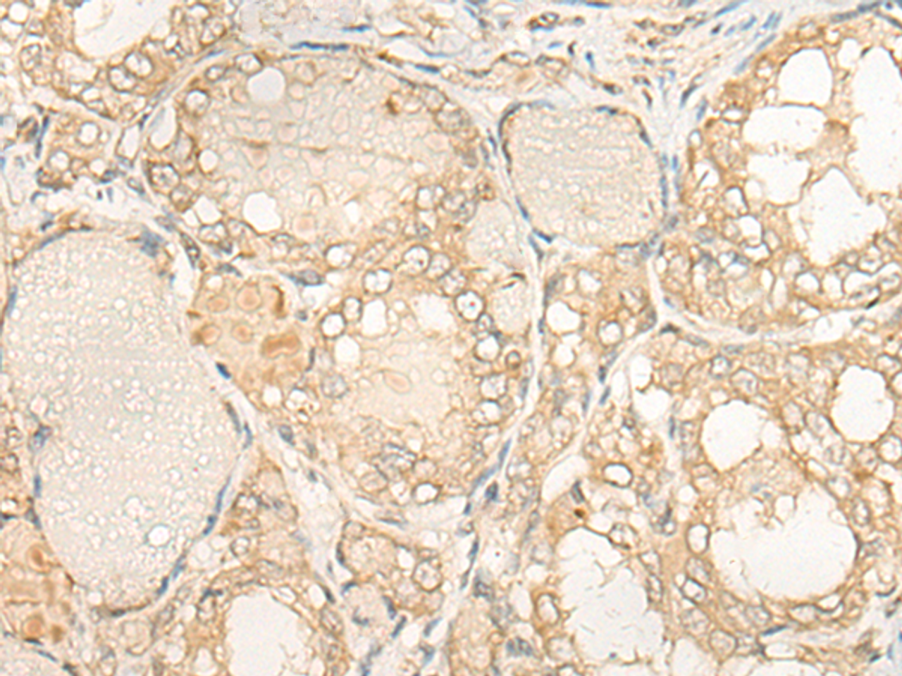 Immunohistochemistry of paraffin-embedded Human thyroid cancer tissue  using DUSP27 Polyclonal Antibody at dilution of 1:50(×200)