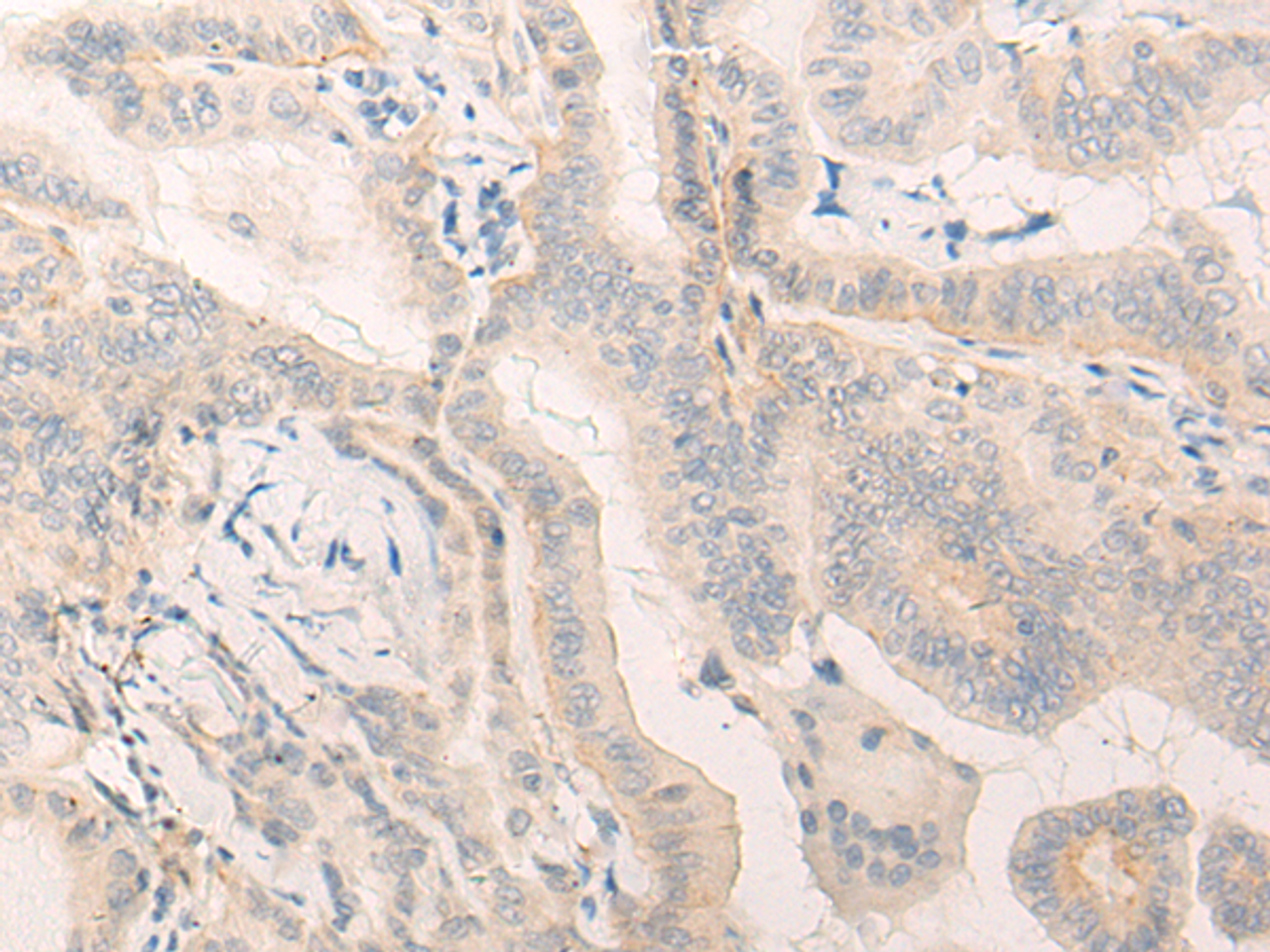 Immunohistochemistry of paraffin-embedded Human thyroid cancer tissue  using ELANE Polyclonal Antibody at dilution of 1:25(×200)