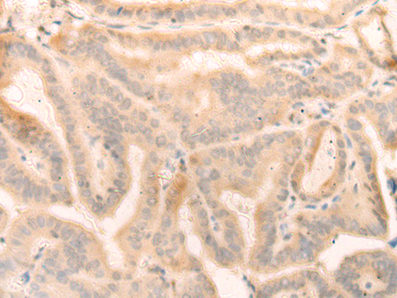 Immunohistochemistry of paraffin-embedded Human thyroid cancer tissue  using ELP4 Polyclonal Antibody at dilution of 1:25(×200)