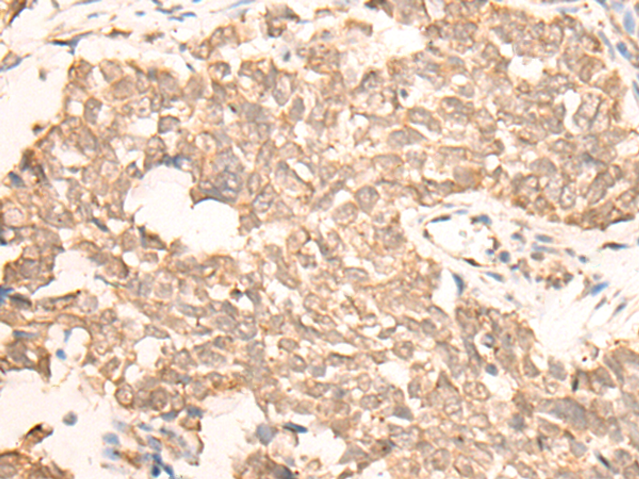 Immunohistochemistry of paraffin-embedded Human lung cancer tissue  using EMSY Polyclonal Antibody at dilution of 1:25(×200)