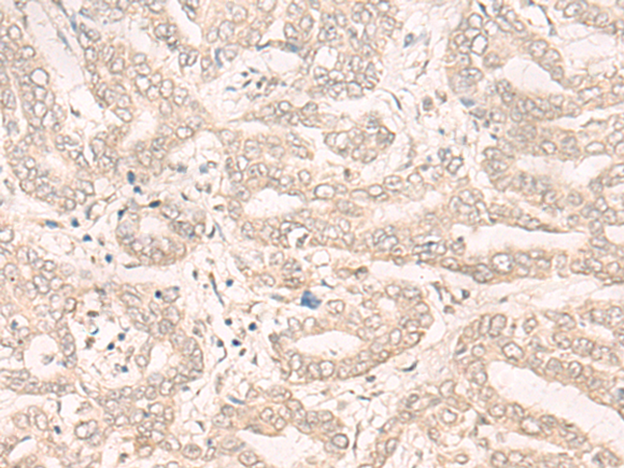 Immunohistochemistry of paraffin-embedded Human liver cancer tissue  using ENO4 Polyclonal Antibody at dilution of 1:30(×200)