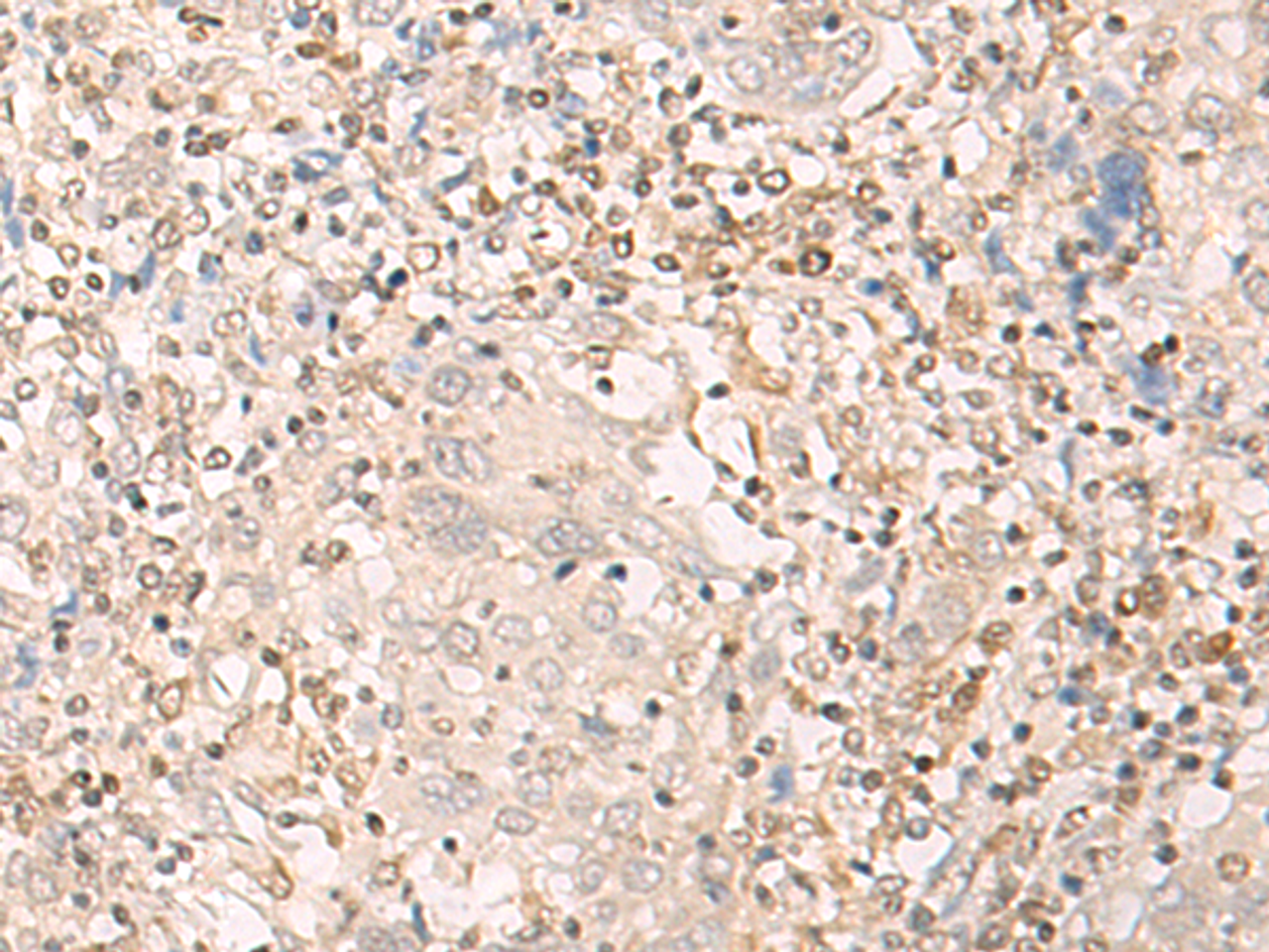 Immunohistochemistry of paraffin-embedded Human cervical cancer tissue  using EPSTI1 Polyclonal Antibody at dilution of 1:25(×200)