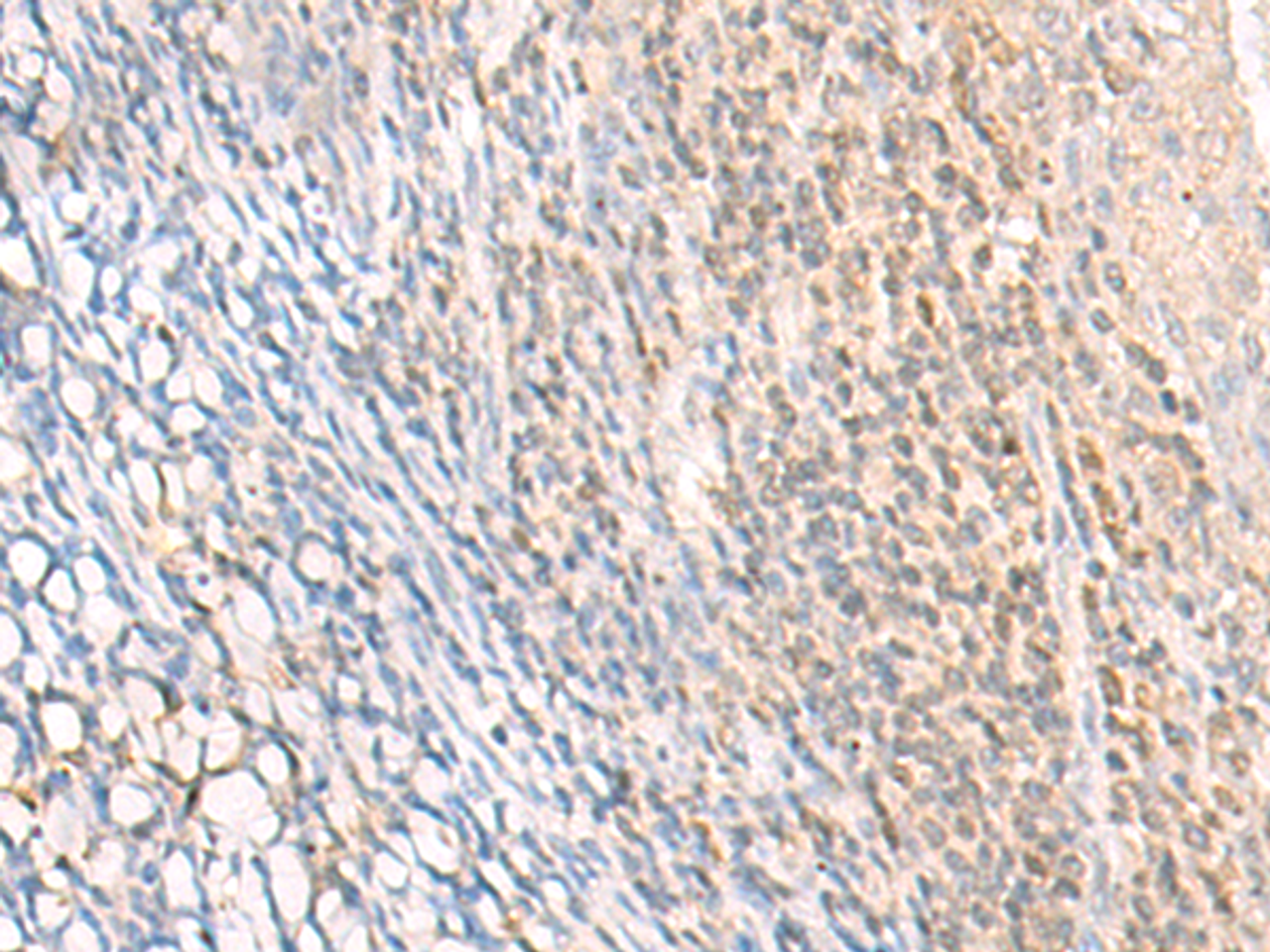 Immunohistochemistry of paraffin-embedded Human tonsil tissue  using EPSTI1 Polyclonal Antibody at dilution of 1:25(×200)