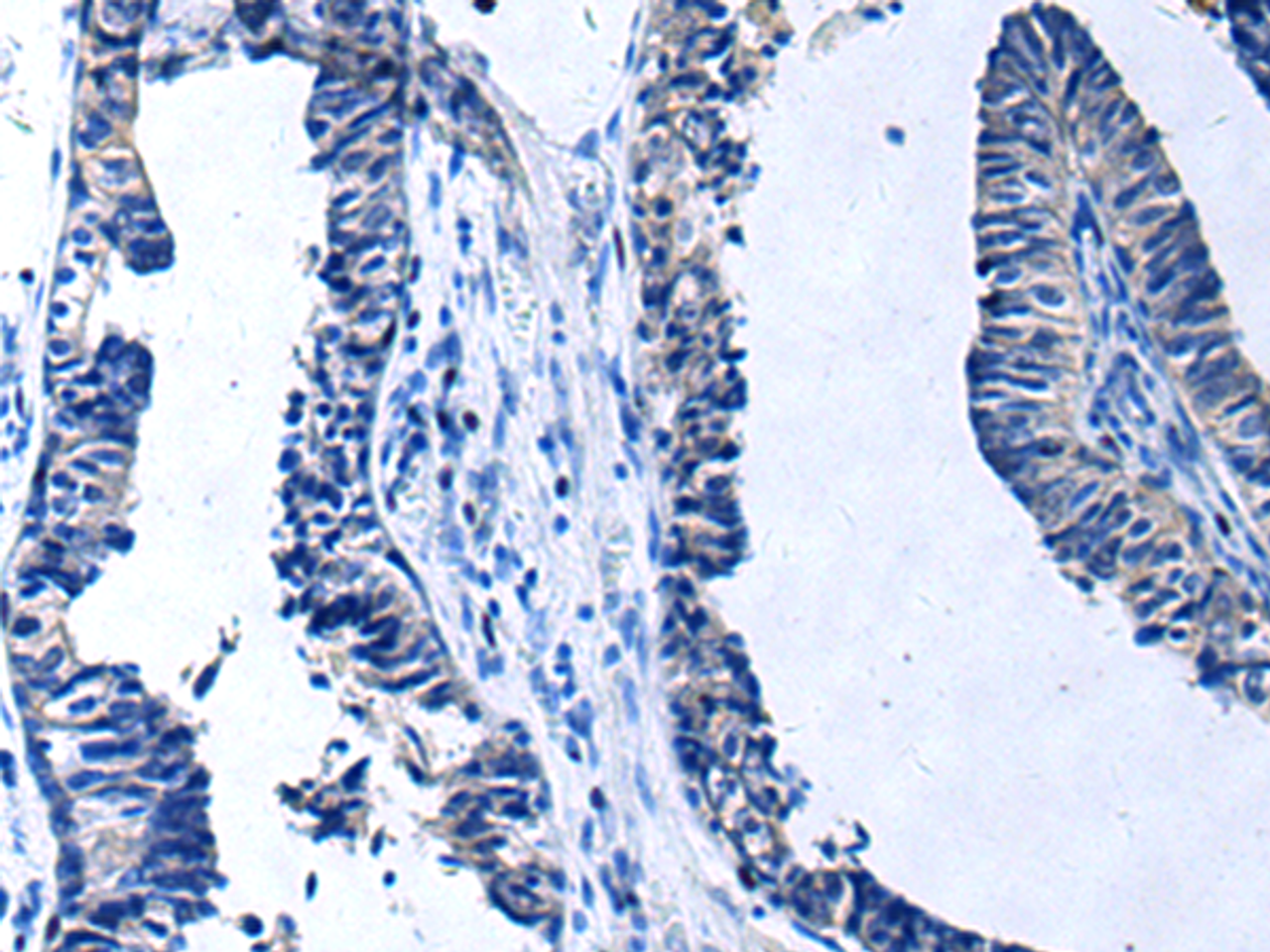 Immunohistochemistry of paraffin-embedded Human prost at e cancer tissue  using PROC Polyclonal Antibody at dilution of 1:80(×200)