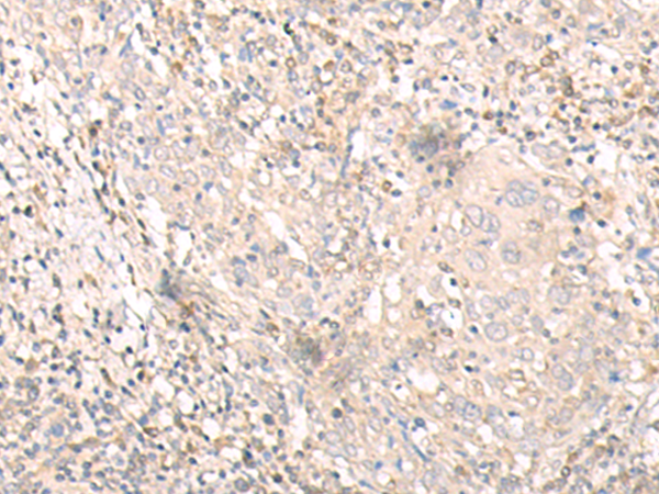 Immunohistochemistry of paraffin-embedded Human cervical cancer tissue  using IL24 Polyclonal Antibody at dilution of 1:30(×200)