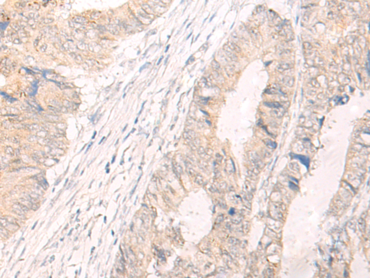 Immunohistochemistry of paraffin-embedded Human colorectal cancer tissue  using IL33 Polyclonal Antibody at dilution of 1:25(×200)
