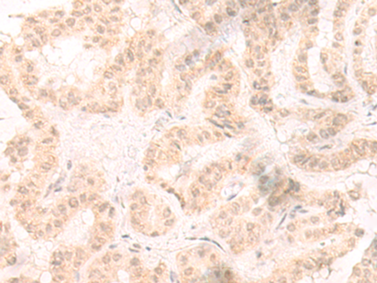 Immunohistochemistry of paraffin-embedded Human thyroid cancer tissue  using IL33 Polyclonal Antibody at dilution of 1:25(×200)