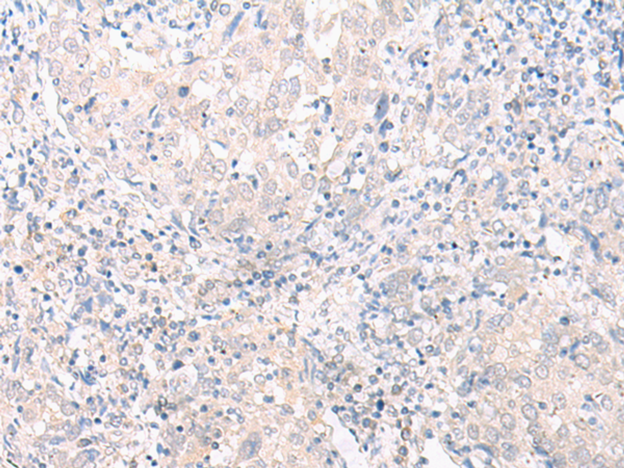 Immunohistochemistry of paraffin-embedded Human cervical cancer tissue  using SLC25A27 Polyclonal Antibody at dilution of 1:30(×200)