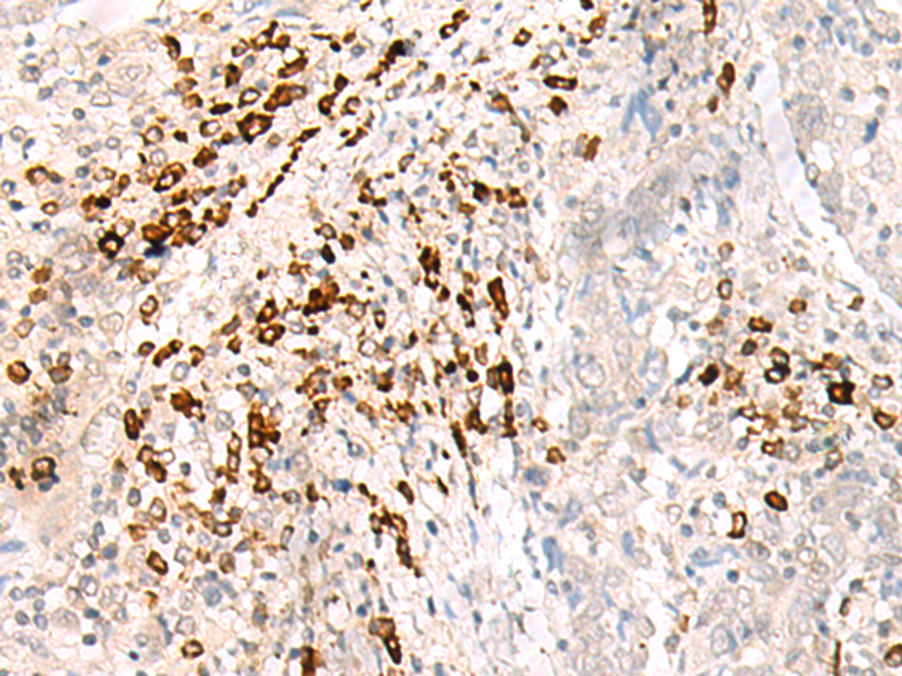 Immunohistochemistry of paraffin-embedded Human cervical cancer tissue  using HLA-B Polyclonal Antibody at dilution of 1:30(×200)