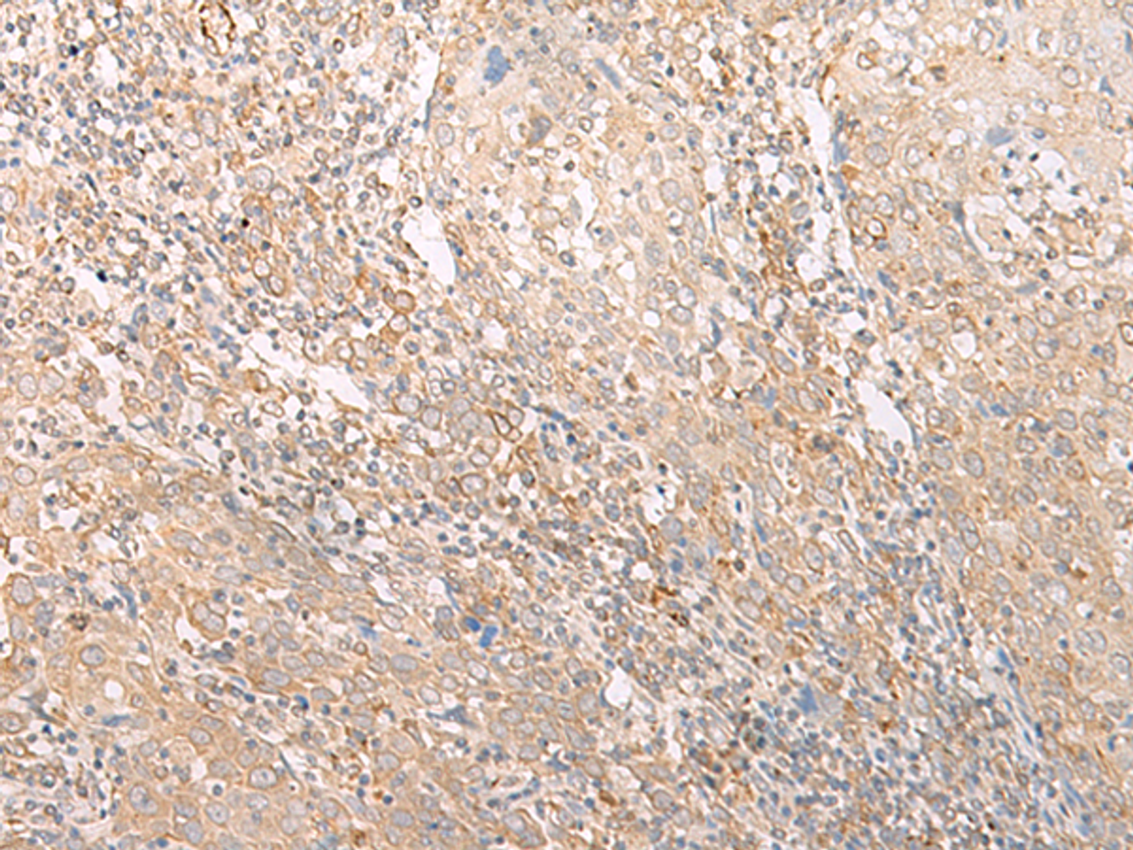 Immunohistochemistry of paraffin-embedded Human cervical cancer tissue  using EPS15 Polyclonal Antibody at dilution of 1:50(×200)