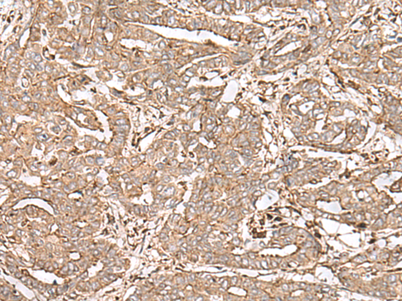 Immunohistochemistry of paraffin-embedded Human liver cancer tissue  using FAAP24 Polyclonal Antibody at dilution of 1:30(×200)