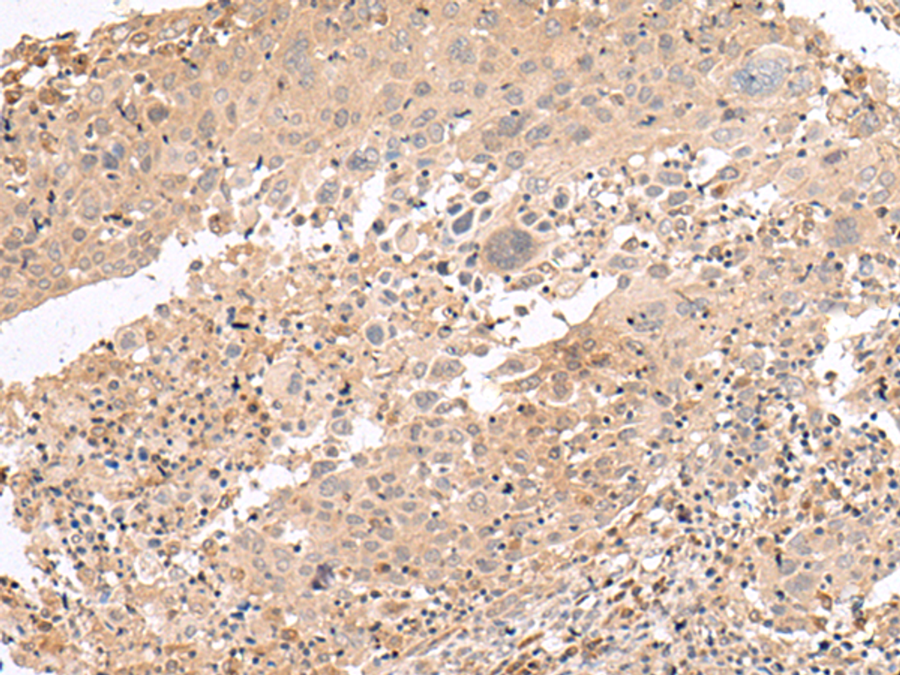 Immunohistochemistry of paraffin-embedded Human cervical cancer tissue  using PATJ Polyclonal Antibody at dilution of 1:45(×200)