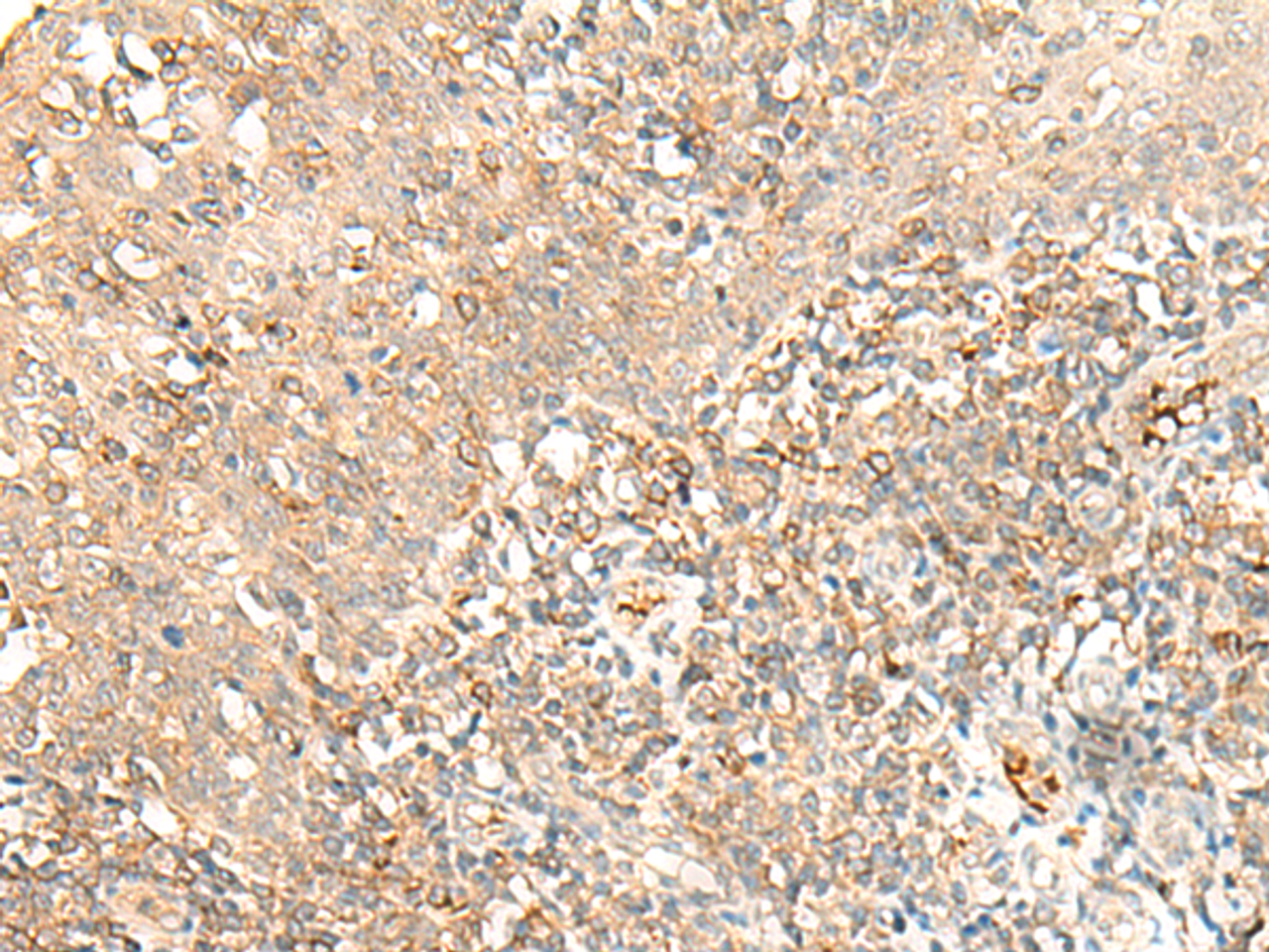 Immunohistochemistry of paraffin-embedded Human tonsil tissue  using MOB3B Polyclonal Antibody at dilution of 1:40(×200)
