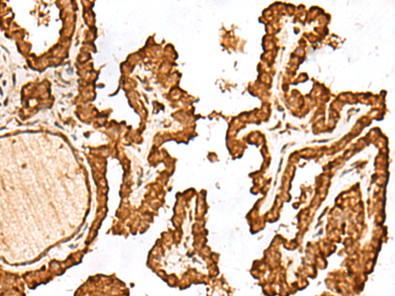 Immunohistochemistry of paraffin-embedded Human thyroid cancer tissue  using FAM200A Polyclonal Antibody at dilution of 1:55(×200)