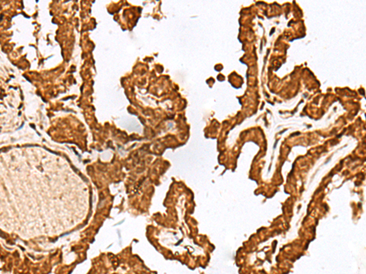 Immunohistochemistry of paraffin-embedded Human thyroid cancer tissue  using FAM50A Polyclonal Antibody at dilution of 1:25(×200)