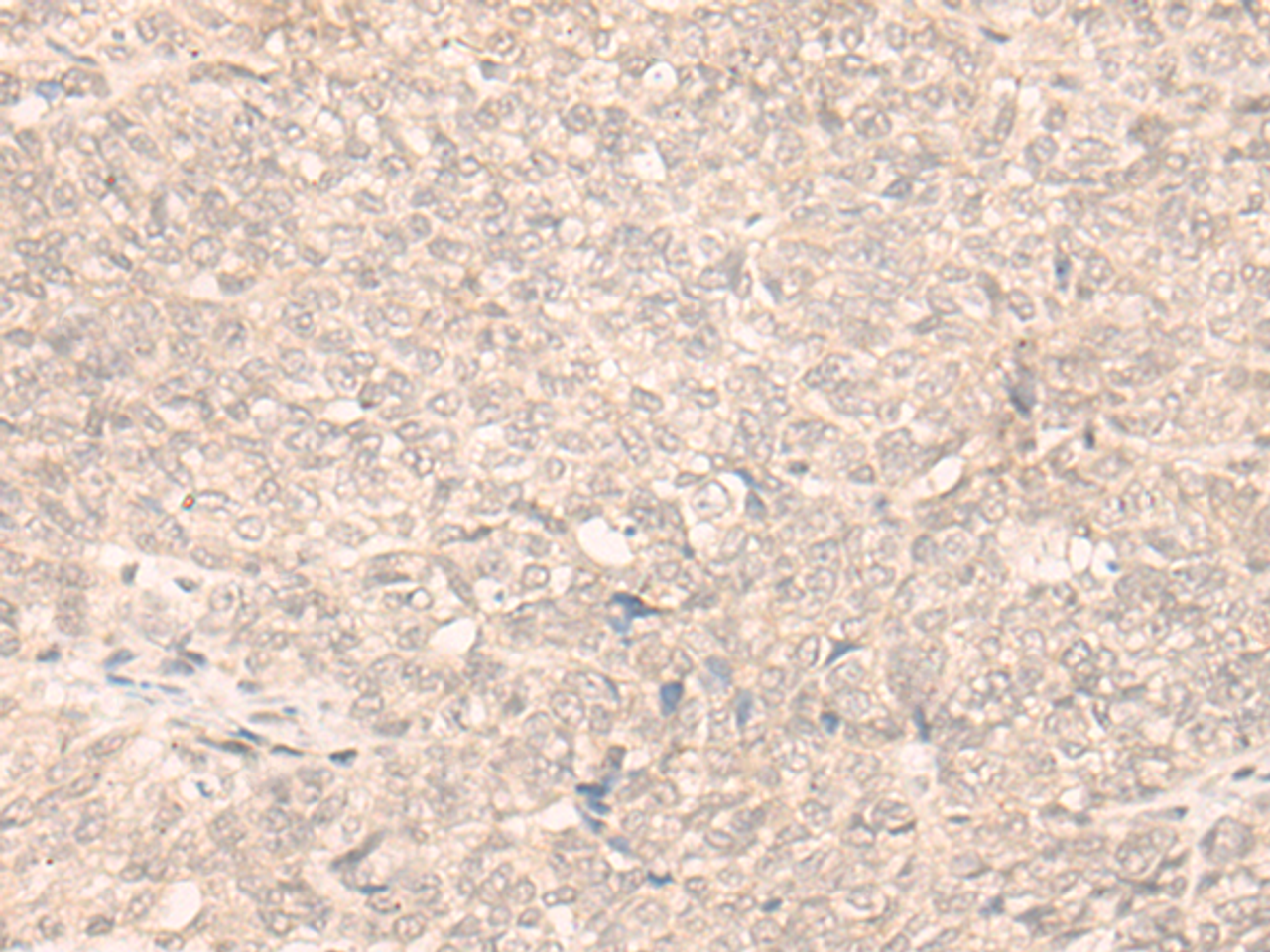 Immunohistochemistry of paraffin-embedded Human ovarian cancer tissue  using FAN1 Polyclonal Antibody at dilution of 1:30(×200)